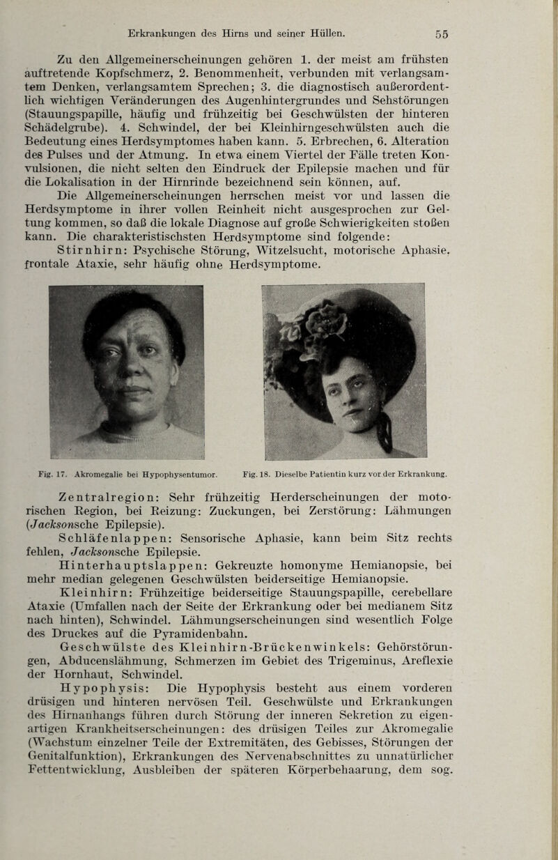 Zu den Allgemeinerscheinungen gehören 1. der meist am frühsten auftretende Kopfschmerz, 2. Benommenheit, verbunden mit verlangsam¬ tem Denken, verlangsamtem Sprechen; 3. die diagnostisch außerordent¬ lich wichtigen Veränderungen des Augenhintergrundes und Sehstörungen (Stauungspapille, häufig und frühzeitig bei Geschwülsten der hinteren Schädelgrube). 4. Schwindel, der bei Kleinhirngeschwülsten auch die Bedeutung eines Herdsymptomes haben kann. 5. Erbrechen, 6. Alteration des Pulses und der Atmung. In etwa einem Viertel der Fälle treten Kon¬ vulsionen, die nicht selten den Eindruck der Epilepsie machen und für die Lokalisation in der Hirnrinde bezeichnend sein können, auf. Die Allgemeinerscheinungen herrschen meist vor und lassen die Herdsymptome in ihrer vollen Reinheit nicht ausgesprochen zur Gel¬ tung kommen, so daß die lokale Diagnose auf große Schwierigkeiten stoßen kann. Die charakteristischsten Herdsymptome sind folgende: Stirnhirn: Psychische Störung, Witzelsucht, motorische Aphasie, frontale Ataxie, sehr häufig ohne Herdsymptome. Fig. 17. Akromegalie bei Hypophysentumor. Fig.18. Dieselbe Patientin kurz vor der Erkrankung. Zentralregion: Sehr frühzeitig Herderscheinungen der moto¬ rischen Region, bei Reizung: Zuckungen, bei Zerstörung: Lähmungen (Jaclcsonsche Epilepsie). Schläfenlappen: Sensorische Aphasie, kann beim Sitz rechts fehlen, Jaclcsonsche Epilepsie. Hinterhauptslappen: Gekreuzte homonyme Hemianopsie, bei mehr median gelegenen Geschwülsten beiderseitige Hemianopsie. Kleinhirn: Frühzeitige beiderseitige Stauungspapille, cerebellare Ataxie (Umfallen nach der Seite der Erkrankung oder bei medianem Sitz nach hinten), Schwindel. Lähmungserscheinungen sind wesentlich Folge des Druckes auf die Pyramidenbahn. Geschwülste des Kleinhirn-Brückenwinkels: Gehörstörun¬ gen, Abducenslähmung, Schmerzen im Gebiet des Trigeminus, Areflexie der Hornhaut, Schwindel. Hypophysis: Die Hypophysis besteht aus einem vorderen drüsigen und hinteren nervösen Teil. Geschwülste und Erkrankungen des Hirnanhangs führen durch Störung der inneren Sekretion zu eigen¬ artigen Krankheitserscheinungen: des drüsigen Teiles zur Akromegalie (Wachstum einzelner Teile der Extremitäten, des Gebisses, Störungen der Genitalfunktion), Erkrankungen des Nervenabschnittes zu unnatürlicher Fettentwicklung, Ausbleiben der späteren Körperbehaarung, dem sog.