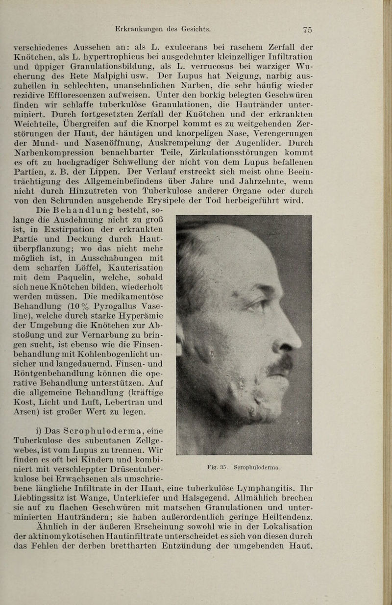 verschiedenes Aussehen an: als L. exulcerans bei raschem Zerfall der Knötchen, als L. hypertrophicus bei ausgedehnter kleinzelliger Infiltration und üppiger Granulationsbildung, als L. verrucosus bei warziger Wu¬ cherung des Rete Malpighi usw. Der Lupus hat Neigung, narbig aus¬ zuheilen in schlechten, unansehnlichen Narben, die sehr häufig wieder rezidive Efflorescenzen auf weisen. Unter den borkig belegten Geschwüren finden wir schlaffe tuberkulöse Granulationen, die Hautränder unter¬ miniert. Durch fortgesetzten Zerfall der Knötchen und der erkrankten Weichteile, Übergreifen auf die Knorpel kommt es zu weitgehenden Zer¬ störungen der Haut, der häutigen und knorpeligen Nase, Verengerungen der Mund- und Nasenöffnung, Auskrempelung der Augenlider. Durch Narbenkompression benachbarter Teile, Zirkulationsstörungen kommt es oft zu hochgradiger Schwellung der nicht von dem Lupus befallenen Partien, z. P>. der Lippen. Der Verlauf erstreckt sich meist ohne Beein¬ trächtigung des Allgemeinbefindens über Jahre und Jahrzehnte, wenn nicht durch Hinzutreten von Tuberkulose anderer Organe oder durch von den Schrunden ausgehende Erysipele der Tod herbeigeführt wird. Die Behandlung besteht, so¬ lange die Ausdehnung nicht zu groß ist, in Exstirpation der erkrankten Partie und Deckung durch Haut¬ überpflanzung; wo das nicht mehr möglich ist, in Ausschabungen mit dem scharfen Löffel, Kauterisation mit dem Paquelin, welche, sobald sich neue Knötchen bilden, wiederholt werden müssen. Die medikamentöse Behandlung (10% Pyrogallus Vase¬ line), welche durch starke Hyperämie der Umgebung die Knötchen zur Ab¬ stoßung und zur Vernarbung zu brin¬ gen sucht, ist ebenso wie die Finsen¬ behandlung mit Kohlenbogenlicht un¬ sicher und langedauernd. Einsen- und Röntgenbehandlung können die ope¬ rative Behandlung unterstützen. Auf die allgemeine Behandlung (kräftige Kost, Licht und Luft, Lebertran und Arsen) ist großer Wert zu legen. i) Das Scropliuloderma, eine Tuberkulose des subcutanen Zellge¬ webes, ist vom Lupus zu trennen. Wir finden es oft bei Kindern und kombi¬ niert mit verschleppter Drüsentuber¬ kulose bei Erwachsenen als umschrie¬ bene längliche Infiltrate in der Haut, eine tuberkulöse Lymphangitis. Ihr Lieblingssitz ist Wange, Unterkiefer und Halsgegend. Allmählich brechen sie auf zu flachen Geschwüren mit matschen Granulationen und unter¬ minierten Hauträndern; sie haben außerordentlich geringe Heiltendenz. Ähnlich in der äußeren Erscheinung sowohl wie in der Lokalisation der aktinomykotischen Hautinfiltrate unterscheidet es sich von diesen durch das Fehlen der derben brettharten Entzündung der umgebenden Haut. Fig. 35. Scrophuloderma.