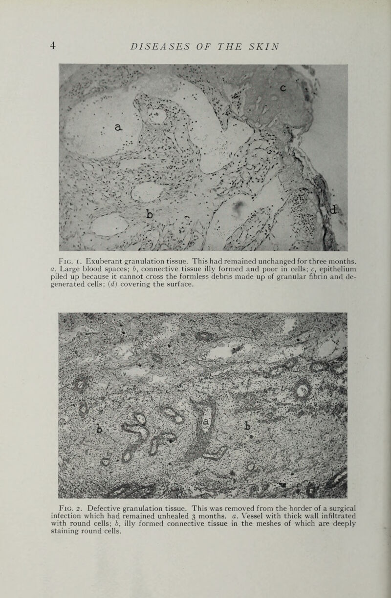 Fig. i. Exuberant granulation tissue. This had remained unchanged for three months. a. Large blood spaces; b, connective tissue illy formed and poor in cells; c, epithelium piled up because it cannot cross the formless debris made up of granular fibrin and de¬ generated cells; (d) covering the surface. Fig. 2. Defective granulation tissue. This was removed from the border of a surgical infection which had remained unhealed 3 months, a. Vessel with thick wall infiltrated with round cells; b, illy formed connective tissue in the meshes of which are deeply staining round cells.