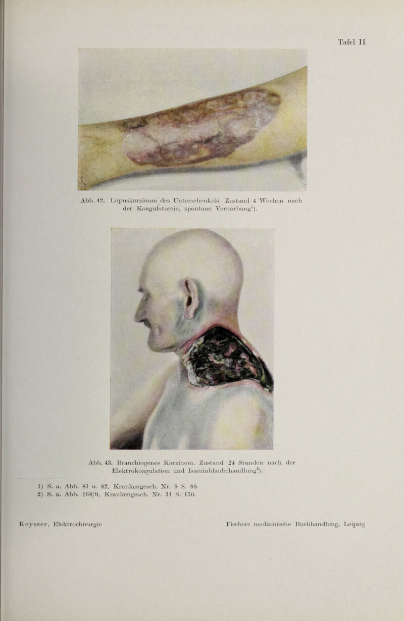 Tafel II Abb. 42. Lupuskarzinom des Unterschenkels. Zustand 4 Wochen nach der Koagulotomie, spontane Vernarbung1). Abb. 43. Branchiogenes Karzinom. Zustand 24 Stunden nach der Elektrokoagulation und Isaminblaubehandlung2). 1) S. a. Abb. 81 u. 82, Krankengesch. Nr. 9 S. 88. 2) S. a. Abb. 168/9, Krankengesch. Nr. 31 S. 150. Keysser, Elektrochirurgio Fischers medizinische Buchhandlung, Leipzig