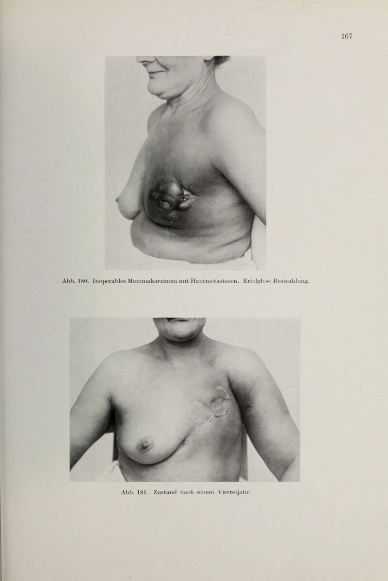 Abb. 180. Inoperables Mammakarzinom mit Hautmetastasen. Erfolglose Bestrahlung. Abb. 181. Zustand nach einem Vierteljahr.