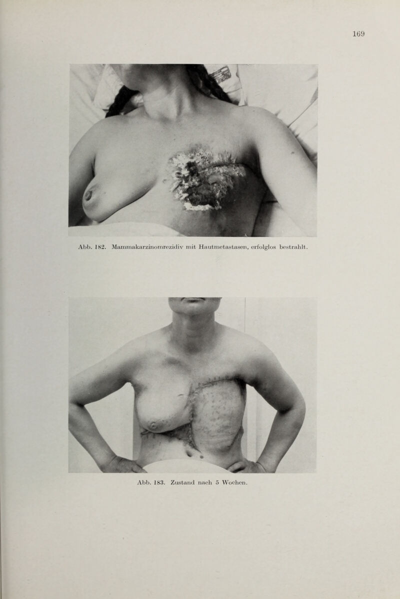 Abb. 182. Mammakarzinomrezidiv mit Hautmetastasen, erfolglos bestrahlt.