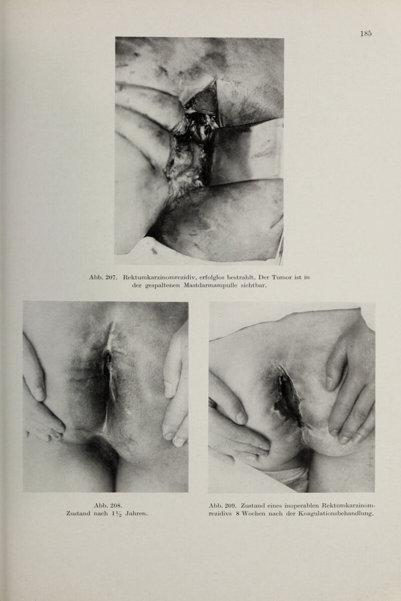 Abb. 207. Rektumkarzinomrezidiv, erfolglos bestrahlt. Der Tumor ist in der gespaltenen Mastdarmampulle sichtbar. Abb. 208. Zustand nach 1 % Jahren. Abb. 209. Zustand eines inoperablen Rektumkarzinom¬ rezidivs 8 Wochen nach der Koagulationsbehandlung.