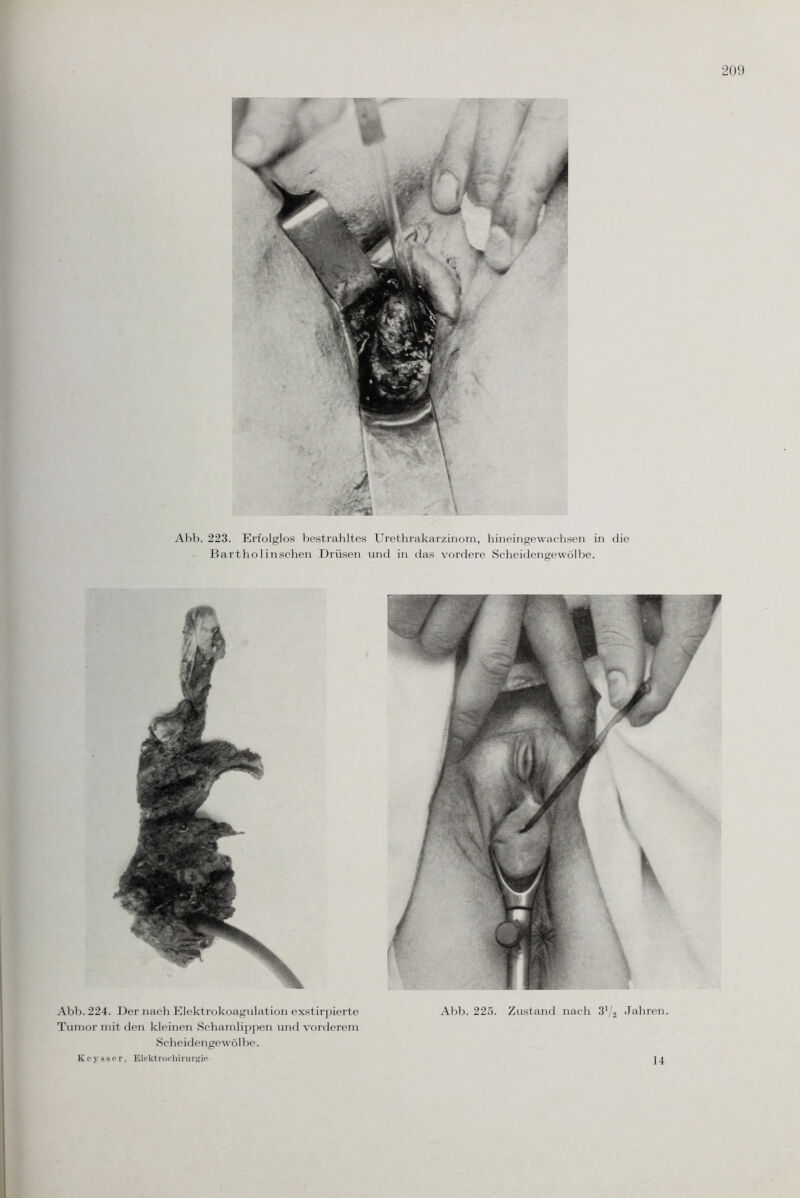 Abb. 223. Erfolglos bestrahltes Urethrakarzinom, hineingewachsen in die Bartho 1 in sehen Drüsen und in das vordere Scheidengewölbe. Abb. 224. Der nach Elektrokoagulation exstirpierte Abb. 225. Zustand nach 3'/2 Jahren. Tumor mit den kleinen Schamlippen und vorderem Scheidengewölbe. Keysser, Elektrochirurgie 14