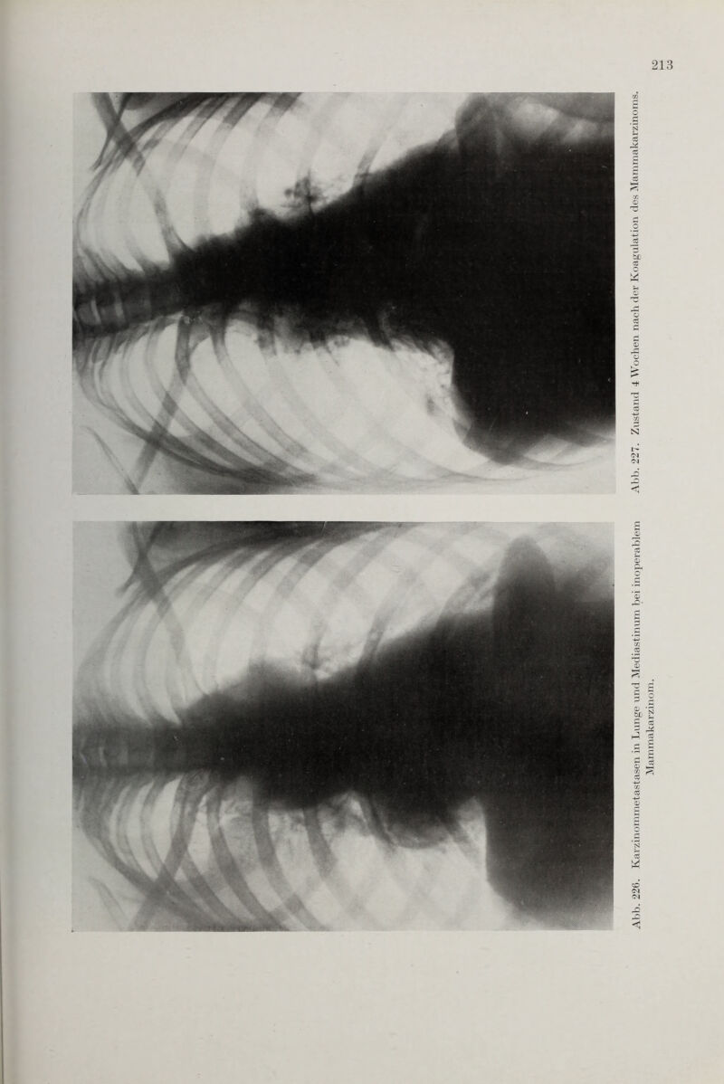 Abb. 226. Karzinommetastasen in Lunge und Mediastinum bei inoperablem Abb. 227. Zustand 4 Wochen nach der Koagulation des Mammakarzinoms. Mammakarzinom.