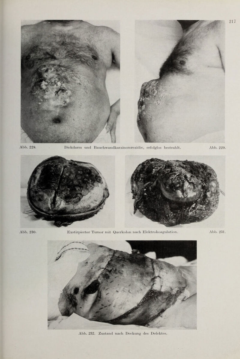 Abb. 228. Dickdarm und Bauchwandkarzinomrezidiv, erfolglos bestrahlt. Abb. 229. Abb. 231. Abb. 230. Exstirpierter Tumor mit Querkolon nach Elektrokoagulation. Abb. 232. Zustand nach Deckung des Defektes.