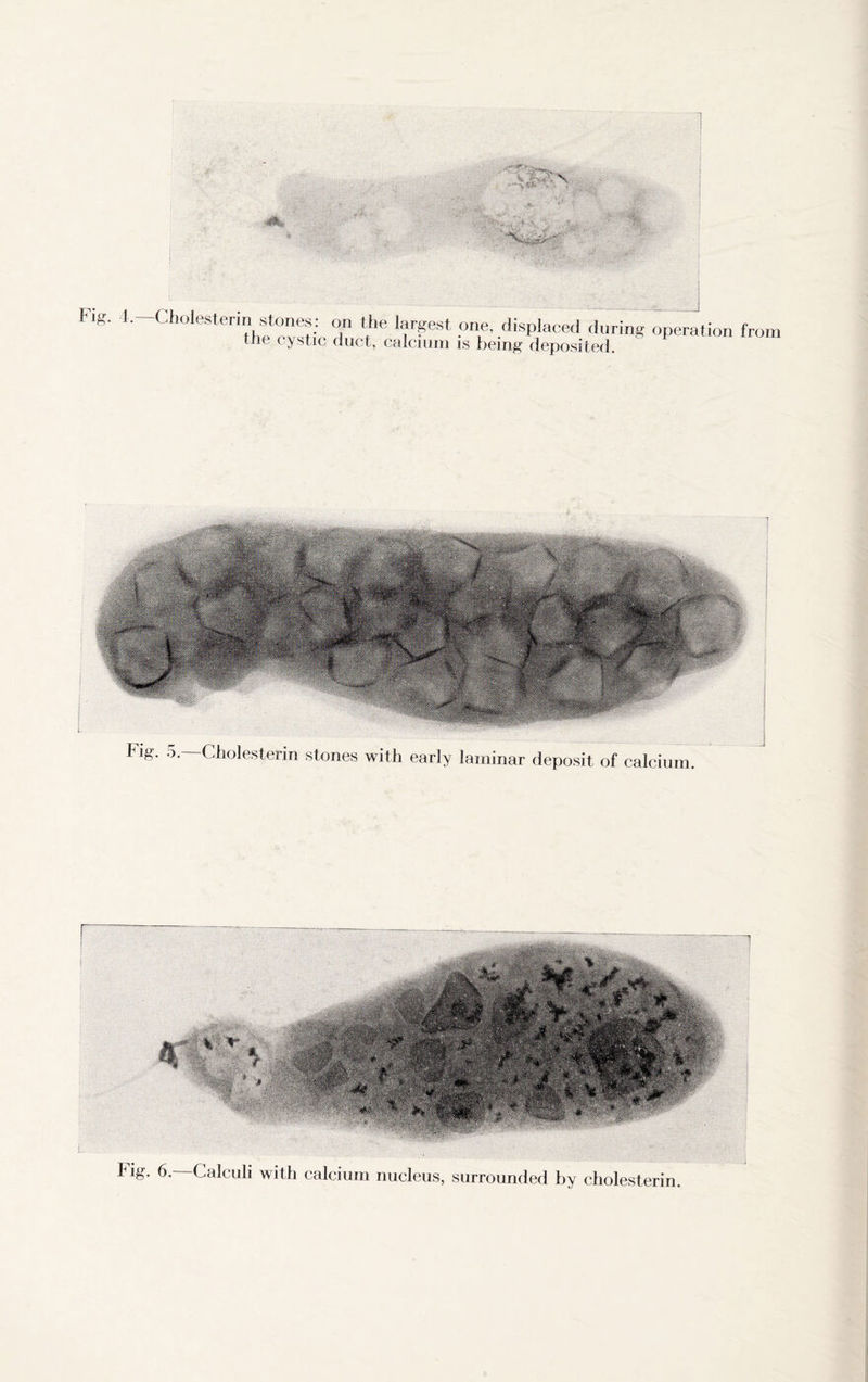 Fie. tilt cystic duct, calcium is being deposited. tig. 5. Cholesterin stones with early laminar deposit of calcium. big. 6. Calculi with calcium nucleus, surrounded by cholesterin.