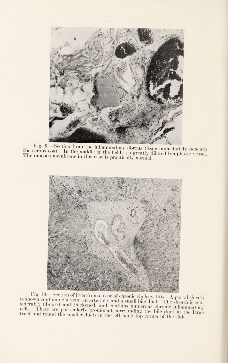 9' S.8C:li°niir°m •!it'n inf!a,nm«tory fibrous tissue immediately beneath The mnenus i eni the.m‘^le of fieW ™ a greatly dilated lymphatic vessel. Ine mucous membrane in this case is practically normal. . , Section of liver from a case of chronic cholecystitis. A portal shea is shown containing a vein, an arteriole, and a small bile duct. The sheath is co ceuT ^hes/ar^rH- ‘Maned- a.nd COntains n“us ^ironic inflammato . : 1 f are particularly prominent surrounding the bile duct in the lar tract and round the smaller ducts in the left-hand top corner of the slide.