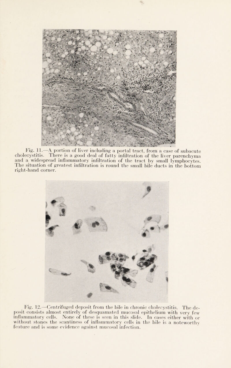 Fig. 11.—A portion of liver including a portal tract, from a case of subacute cholecystitis. There is a good deal of fatty infiltration of the liver parenchyma and a widespread inflammatory infiltration of the tract by small lymphocytes. The situation of greatest infiltration is round the small bile ducts in the bottom right-hand corner. Fig. 12.—Centrifuged deposit from the bile in chronic cholecystitis. The de¬ posit consists almost entirely of desquamated mucosal epithelium with very few inflammatory cells. None of these is seen in this slide. In cases either with or without stones the scantiness of inflammatory cells in the bile is a noteworthy feature and is some evidence against mucosal infection.