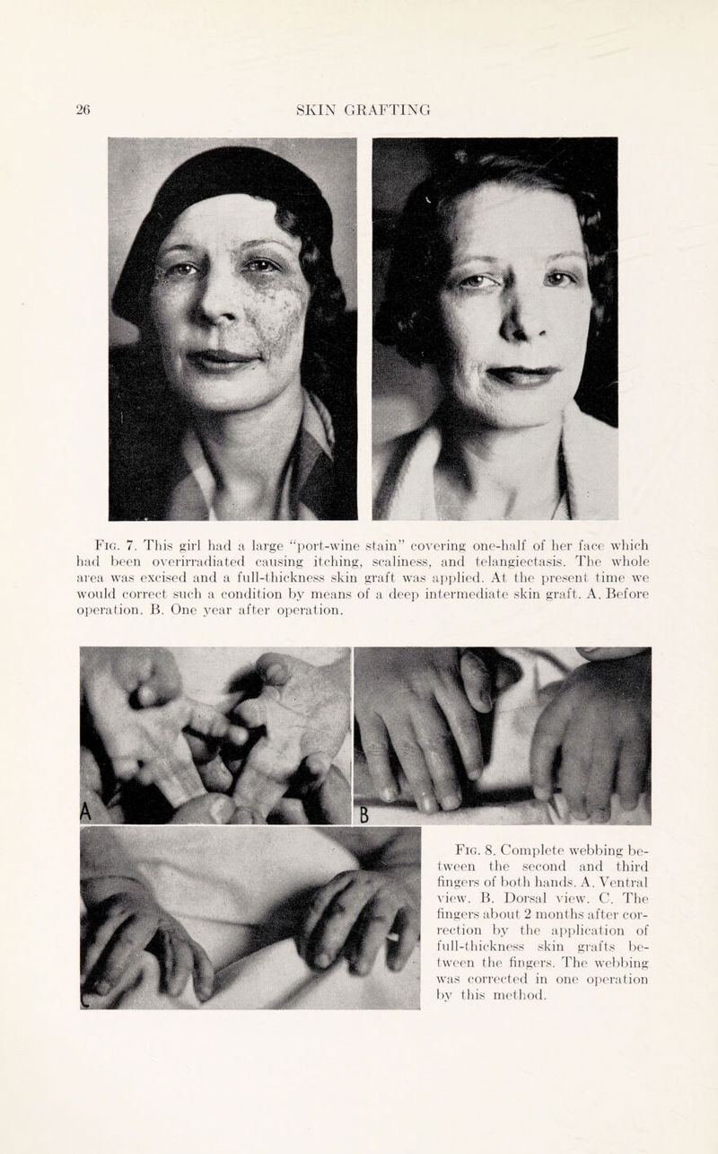 Fig. 7. This girl had a large “port-wine stain” covering one-half of her face which had been overirradiated causing itching, scaliness, and telangiectasis. The whole area was excised and a full-thickness skin graft was applied. At the present time we would correct such a condition by means of a deep intermediate skin graft. A. Before operation. B. One year after operation. Fig. 8. Complete webbing be¬ tween the second and third fingers of both hands. A. Ventral view. B. Dorsal view. C. The fingers about 2 months after cor¬ rection by the application of full-thickness skin grafts be¬ tween the fingers. The webbing was corrected in one operation by this method.