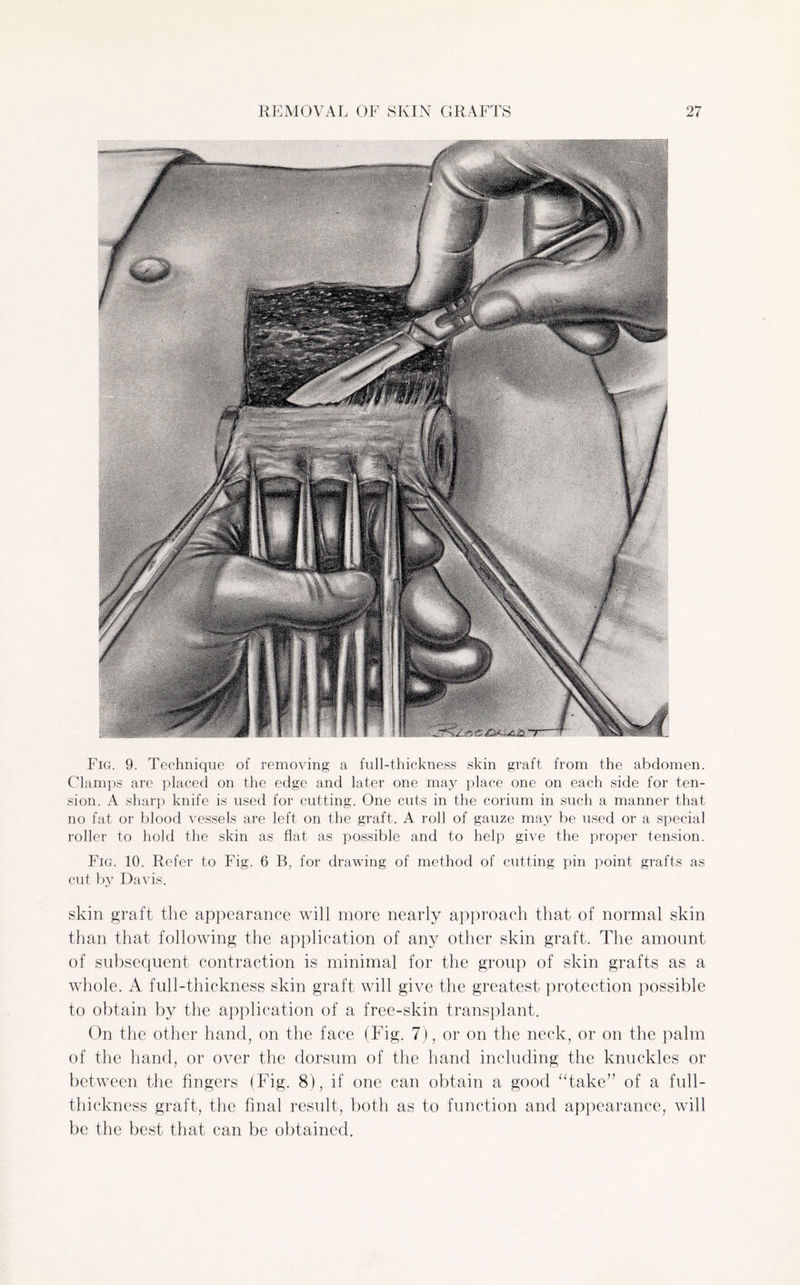 Fig. 9. Technique of removing a full-thickness skin graft from the abdomen. Clamps are placed on the edge and later one may place one on each side for ten¬ sion. A sharp knife is used for cutting. One cuts in the corium in such a manner that no fat or blood vessels are left on the graft. A roll of gauze may be used or a special roller to hold the skin as flat as possible and to help give the proper tension. Fig. 10. Refer to Fig. 6 B, for drawing of method of cutting pin point grafts as cut bj^ Davis. skin graft the appearance will more nearly approach that of normal skin than that following the application of any other skin graft. The amount of subsequent contraction is minimal for the group of skin grafts as a whole. A full-thickness skin graft will give the greatest protection possible to obtain by the application of a free-skin transplant. On the other hand, on the face (Fig. 7), or on the neck, or on the palm of the hand, or over the dorsum of the hand including the knuckles or between the fingers (Fig. 8), if one can obtain a good “take” of a full¬ thickness graft, the final result, both as to function and appearance, will be the best that can be obtained.