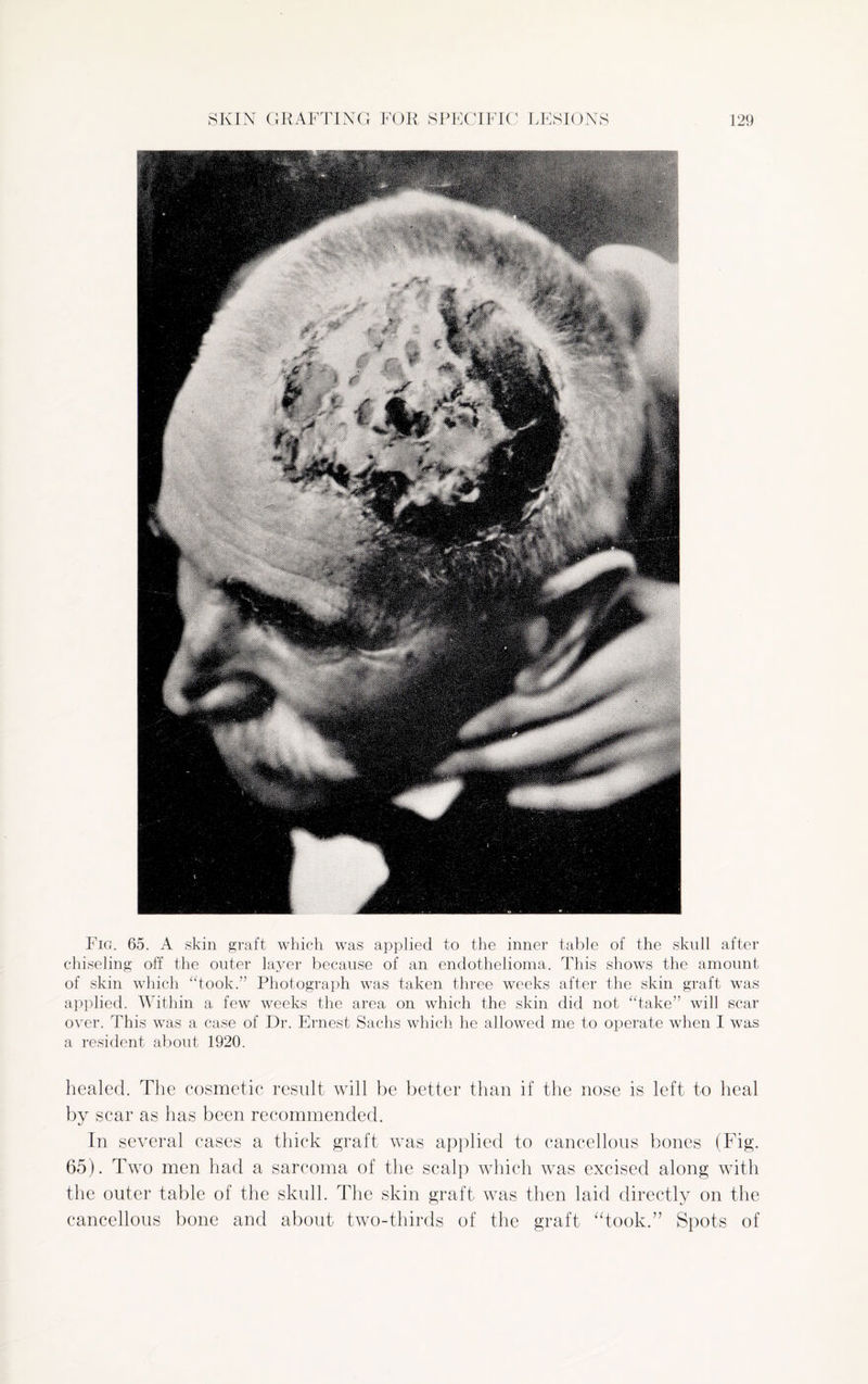 Fig. 65. A skin graft which was applied to the inner table of the skull after chiseling off the outer layer because of an endothelioma. This shows the amount of skin which “took.” Photograph was taken three weeks after the skin graft was applied. Within a few weeks the area on which the skin did not “take” will scar over. This was a case of Dr. Ernest Sachs which he allowed me to operate when I was a resident about 1920. healed. The cosmetic result will be better than if the nose is left to heal by scar as has been recommended. In several cases a thick graft was applied to cancellous bones (Fig. 65). Two men had a sarcoma of the scalp which was excised along with the outer table of the skull. The skin graft was then laid directly on the cancellous bone and about two-thirds of the graft “took.” Spots of