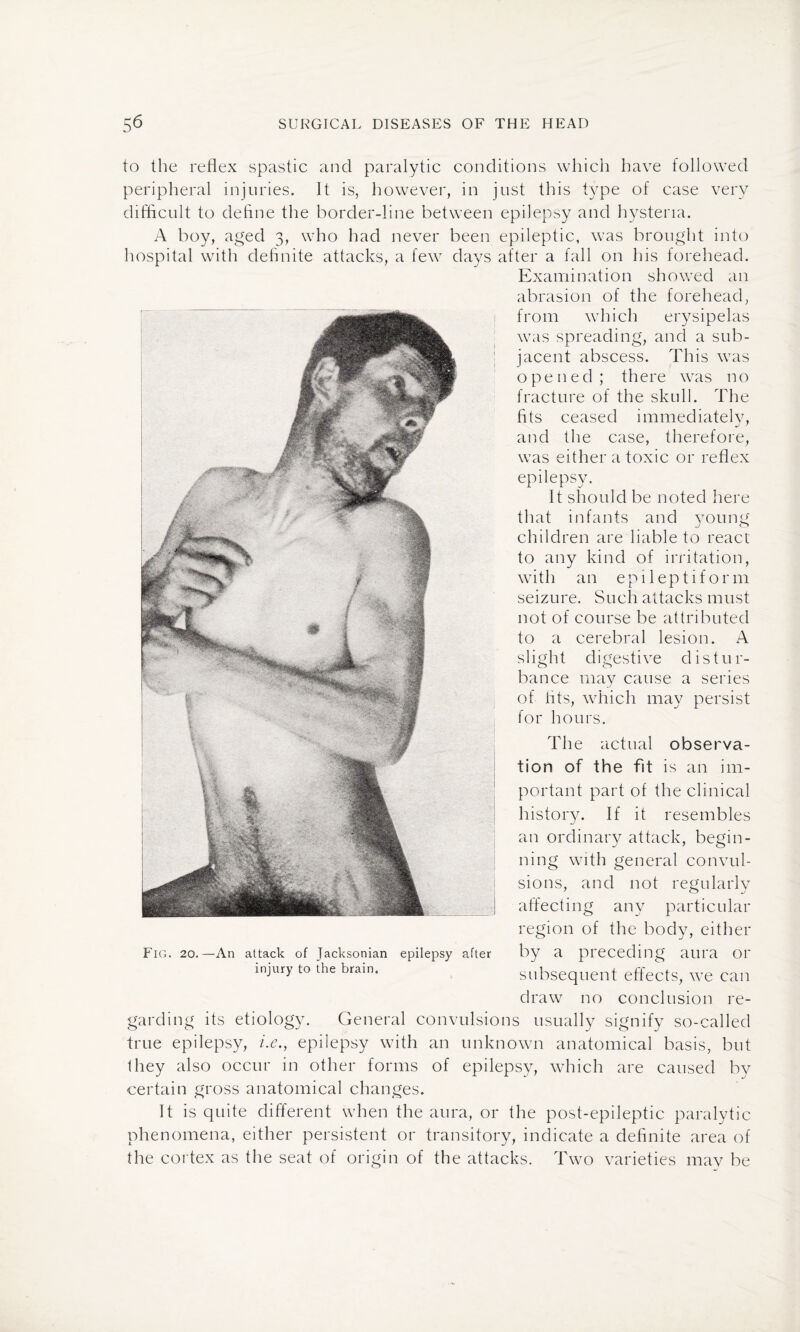 to the reflex spastic and paralytic conditions which have followed peripheral injuries. It is, however, in just this type of case very difficult to define the border-line between epilepsy and hysteria. A boy, aged 3, who had never been epileptic, was brought into hospital with definite attacks, a few days after a fall on his forehead. Examination showed an abrasion of the forehead, from which erysipelas Fig. 20.—An attack of Jacksonian epilepsy injury to the brain. was spreading, and a sub¬ jacent abscess. This was o pened ; th ere was no fracture of the skull. The fits ceased immediately, and the case, therefore, was either a toxic or reflex epilepsy. It should be noted here that infants and young children are liable to react to any kind of irritation, with an epileptiform seizure. Such attacks must not of course be attributed to a cerebral lesion. A slight digestive distur¬ bance may cause a series of fits, which may persist for hours. The actual observa¬ tion of the fit is an im¬ portant part of the clinical history. If it resembles an ordinary attack, begin¬ ning with general convul¬ sions, and not regularly affecting any particular region of the body, either after by a preceding aura or subsequent effects, we can draw no conclusion re¬ garding its etiology. General convulsions usually signify so-called true epilepsy, i.e., epilepsy with an unknown anatomical basis, but they also occur in other forms of epilepsy, which are caused by certain gross anatomical changes. It is quite different when the aura, or the post-epileptic paralytic phenomena, either persistent or transitory, indicate a definite area of the cortex as the seat of origin of the attacks. Two varieties may be