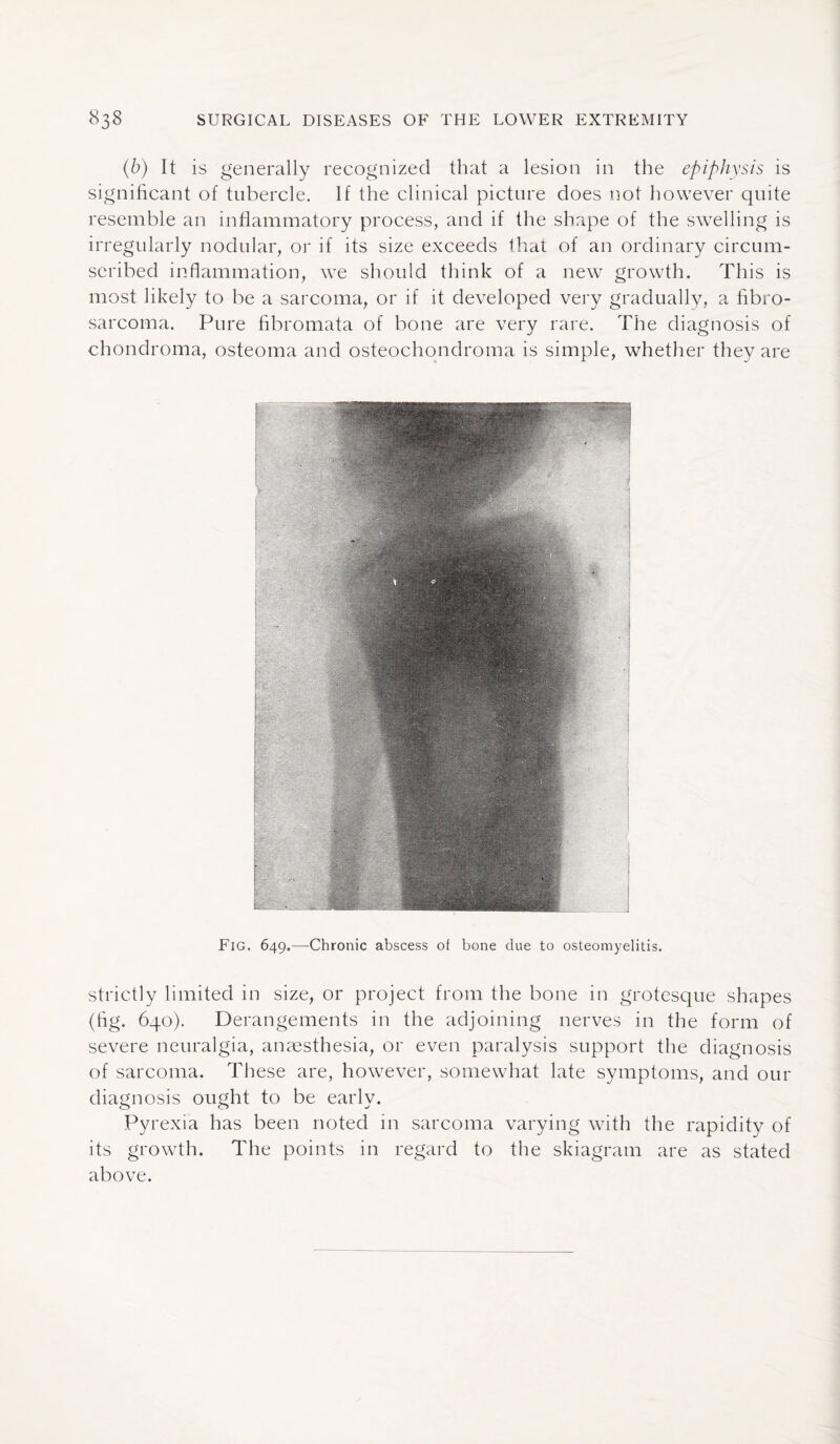 (b) It is generally recognized that a lesion in the epiphysis is significant of tubercle. If the clinical picture does not however quite resemble an inflammatory process, and if the shape of the swelling is irregularly nodular, or if its size exceeds that of an ordinary circum¬ scribed inflammation, w7e should think of a new growth. This is most likely to be a sarcoma, or if it developed very gradually, a fibro¬ sarcoma. Pure fibromata of bone are very rare. The diagnosis of chondroma, osteoma and osteochondroma is simple, whether they are Fig. 649.—Chronic abscess of bone due to osteomyelitis. strictly limited in size, or project from the bone in grotesque shapes (fig. 640). Derangements in the adjoining nerves in the form of severe neuralgia, anaesthesia, or even paralysis support the diagnosis of sarcoma. These are, however, somewhat late symptoms, and our diagnosis ought to be early. Pyrexia has been noted in sarcoma varying with the rapidity of its growth. The points in regard to the skiagram are as stated above.