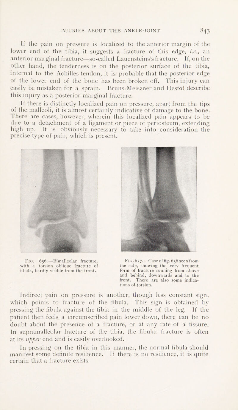 If the pain on pressure is localized to the anterior margin of the lower end of the tibia, it suggests a fracture of this edge, i.e.} an anterior marginal fracture—so-called Lauensteins’s fracture. If, on the other hand, the tenderness is on the posterior surface of the tibia, internal to the Achilles tendon, it is probable that the posterior edge of the lower end of the bone has been broken off. This injury can easily be mistaken for a sprain. Bruns-Meiszner and Destot describe this injury as a posterior marginal fracture. If there is distinctly localized pain on pressure, apart from the tips of the malleoli, it is almost certainly indicative of damage to the bone. There are cases, however, wherein this localized pain appears to be due to a detachment of a ligament or piece of periosteum, extending high up. It is obviously necessary to take into consideration the precise type of pain, which is present. Fig. 656.—Bimalleolar fracture, with a torsion oblique fracture of fibula, hardly visible from the front. Fig. 657.—Case of fig. 656 seen from the side, showing the very frequent form of fracture running from above and behind, downwards and to the front. There are also some indica¬ tions of torsion. Indirect pain on pressure is another, though less constant sign, which points to fracture of the fibula. This sign is obtained by pressing the fibula against the tibia in the middle of the leg. If the patient then feels a circumscribed pain lower down, there can be no doubt about the presence of a fracture, or at any rate of a fissure. In supramalleolar fracture of the tibia, the fibular fracture is often at its upper end and is easily overlooked. In pressing on the tibia in this manner, the normal fibula should manifest some definite resilience. If there is no resilience, it is quite certain that a fracture exists.