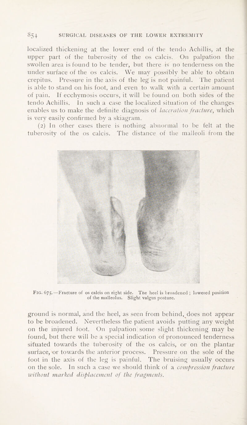 localized thickening at the lower end of the tendo Achillis, at the upper part of the tuberosity of the os calcis. On palpation the swollen area is found to be tender, but there is no tenderness on the under surface of the os calcis. We may possibly be able to obtain crepitus. Pressure in the axis of the leg is not painful. The patient is able to stand on his foot, and even to walk with a certain amount of pain. If ecchymosis occurs, it will be found on both sides of the tendo Achillis. In such a case the localized situation of the changes enables us to make the definite diagnosis of laceration fracture, which is very easily confirmed by a skiagram. (2) In other cases there is nothing abnormal to be felt at the tuberosity of the os calcis. The distance of the malleoli from the Fig. 675.—Fracture of os calcis on right side. The heel is broadened ; lowered position of the malleolus. Slight valgus posture. ground is normal, and the heel, as seen from behind, does not appear to be broadened. Nevertheless the patient avoids putting any weight on the injured foot. On palpation; some slight thickening may be found, but there will be a special indication of pronounced tenderness situated towards the tuberosity of the os calcis, or on the plantar surface, or towards the anterior process. Pressure on the sole of the foot in the axis of the leg is painful. The bruising usually occurs on the sole. In such a case we should think of a compression fracture without marked displacement of the fragments.