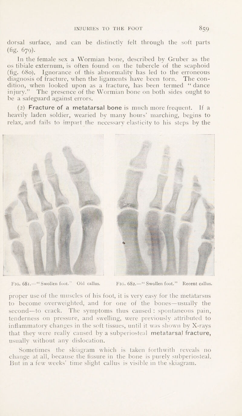 dorsal surface, and can be distinctly felt through the soft parts (fig. 679). In the female sex a Wormian bone, described by Gruber as the os tibiale externum, is often found on the tubercle of the scaphoid (fig. 680). Ignorance of this abnormality has led to the erroneous diagnosis of fracture, when the ligaments have been torn. The con¬ dition, when looked upon as a fracture, has been termed “ dance injury.” The presence of the Wormian bone on both sides ought to be a safeguard against errors. (2) Fracture of a metatarsal bone is much more frequent. If a heavily laden soldier, wearied by many hours’ marching, begins to relax, and fails to impart the necessary elasticity to his steps by the Fig. 681.■—•“ Swollen foot. Old callus. Fig. 682.—“ Swollen foot.” Recent callus. proper use of the muscles of his foot, it is very easy for the metatarsus to become overweighted, and for one of the bones—usually the second—to crack. The symptoms thus caused : spontaneous pain, tenderness on pressure, and swelling, were previously attributed to inflammatory changes in the soft tissues, until it was shown by X-rays that they were really caused by a subperiosteal metatarsal fracture, usually without any dislocation. Sometimes the skiagram which is taken forthwith reveals no change at all, because the fissure in the bone is purely subperiosteal. But in a few weeks’ time slight callus is visible in the skiagram.