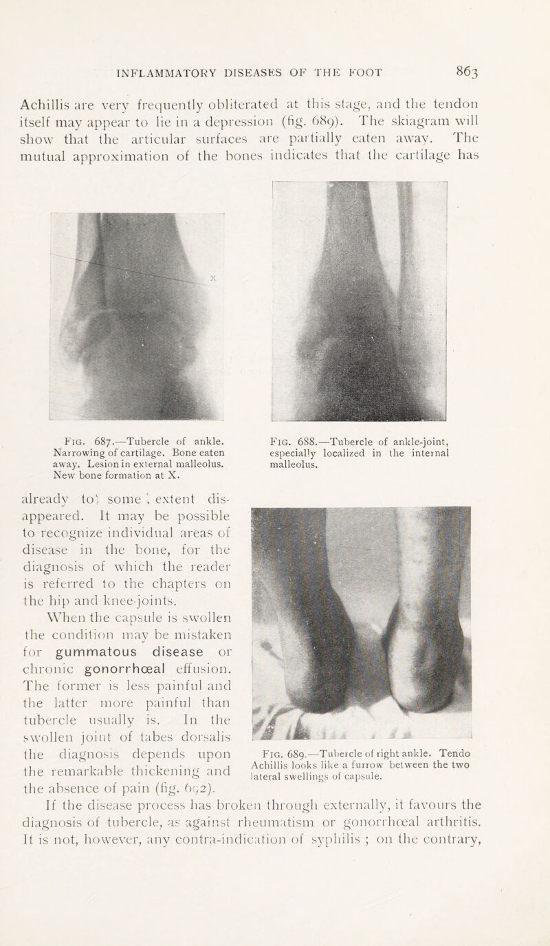 Achillis are very frequently obliterated at this stage, and the tendon itself may appear to lie in a depression (fig. 689). The skiagram will show that the articular surfaces are partially eaten away. The mutual approximation of the bones indicates that the cartilage has Fig. 687.—Tubercle of ankle. Fig. 688.—Tubercle of ankle-joint, Narrowing of cartilage. Bone eaten especially localized in the internal away. Lesion in external malleolus. malleolus. New bone formation at X. already to; some • extent dis¬ appeared. It may be possible to recognize individual areas of disease in the bone, for the diagnosis of which the reader is referred to the chapters on the hip and knee-joints. When the capsule is swollen the condition may be mistaken for gummatous disease or chronic gonorrhoeal effusion. The former is less painful and the latter more painful than tubercle usually is. In the swollen joint of tabes dorsalis the diagnosis depends upon the remarkable thickening and the absence of pain (fig. 632). If the disease process has broken through externally, it favours the diagnosis of tubercle, as against rheumatism or gonorrhoeal arthritis. It is not, however, any contra-indication of syphilis ; on the contrary, Fig. 689.—:Tubercle of right ankle. Tendo Achillis looks like a furrow between the two lateral swellings of capsule.