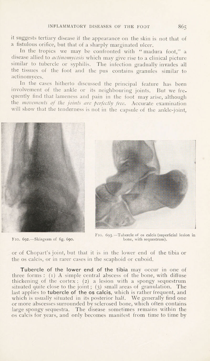 it suggests tertiary disease if the appearance on the skin is not that of a fistulous orifice, but that of a sharply marginated ulcer. In the tropics we may be confronted with “ madura foot,” a disease allied to actinomycosis which may give rise to a clinical picture similar to tubercle or syphilis. The infection gradually invades all the tissues ot the foot and the pus contains granules similar to actinomyces. In the cases hitherto discussed the principal feature has been involvement of the ankle or its neighbouring joints. But we fre¬ quently find that lameness and pain in the foot may arise, although the movements of the joints are perfectly free. Accurate examination will show that the tenderness is not in the capsule of the ankle-joint, FlG. 692.—Skiagram of fig. 690. Fig. 693.—Tubercle of os calcis (superficial lesion bone, with sequestrum). or of Chopart’s joint, but that it is in the lower end of the tibia or the os calcis, or in rarer cases in the scaphoid or cuboid. Tubercle of the lower end of the tibia may occur in one of three forms : (i) A simple central abscess of the bone, with diffuse thickening of the cortex ; (2) a lesion with a spongy sequestrum situated quite close to the joint; (3) small areas of granulation. The last applies to tubercle of the os calcis, which is rather frequent, and which is usually situated in its posterior half. We generally find one or more abscesses surrounded by sclerosed bone, which often contains large spongy sequestra. The disease sometimes remains within the os calcis for years, and only becomes manifest from time to time by