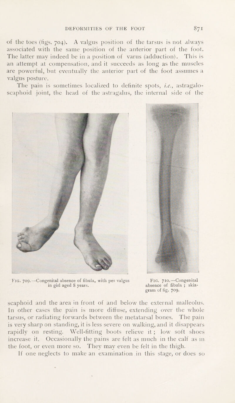 of the toes (figs. 704). A valgus position of the tarsus is not always associated with the same position of the anterior part of the foot. The latter may indeed be in a position of varus (adduction). This is an attempt at compensation, and it succeeds as long as the muscles are powerful, but eventually the anterior part of the foot assumes a valgus posture. The pain is sometimes localized to definite spots, i.e., astragalo- scaphoid joint, the head of the astragalus, the internal side of the Fig. 709.—Congenital absence of fibula, with pes valgus Fig. 7ic>-—Congenital in girl aged 8 years. absence of fibula ; skia¬ gram of fig. 7°9- scaphoid and the area in front of and below the external malleolus. In other cases the pain is more diffuse, extending over the whole tarsus, or radiating forwards between the metatarsal bones. The pain is very sharp on standing, it is less severe on walking, and it disappears rapidly on resting. Well-fitting boots relieve it. ; low soft shoes increase it. Occasionally the pains are felt as much in the calf as in the foot, or even more so. They may even be felt in the thigh. If one neglects to make an examination in this stage, or does so