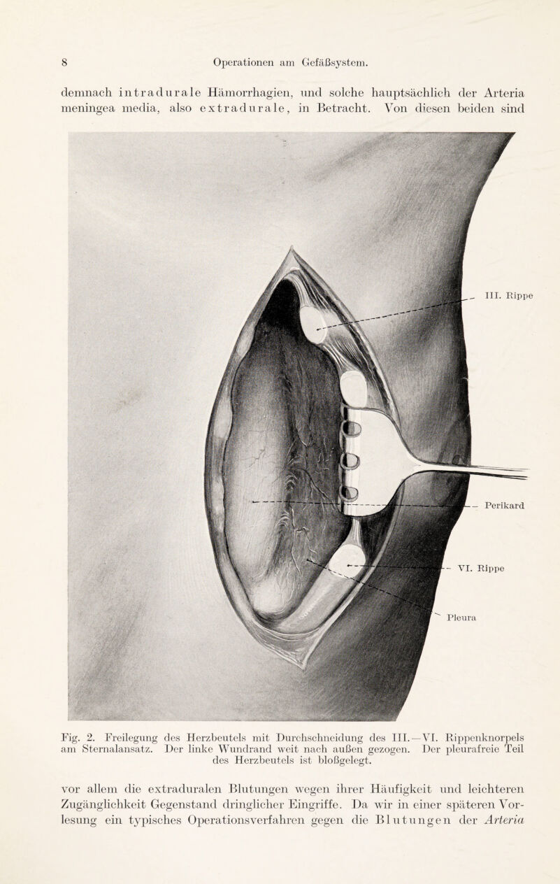 demnach intradurale Hämorrhagien, und solche hauptsächlich der Arteria meningea media, also extradurale, in Betracht. Von diesen beiden sind Fig. 2. Freilegung des Herzbeutels mit Durchschneidung des III.—VI. Rippenknorpels am Sternalansatz. Der linke Wundrand weit nach außen gezogen. Der pleurafreie Teil des Herzbeutels ist bloßgelegt. vor allem die extraduralen Blutungen wegen ihrer Häufigkeit und leichteren Zugänglichkeit Gegenstand dringlicher Eingriffe. Da wir in einer späteren Vor¬ lesung ein typisches Operationsverfahren gegen die Blutungen der Arteria