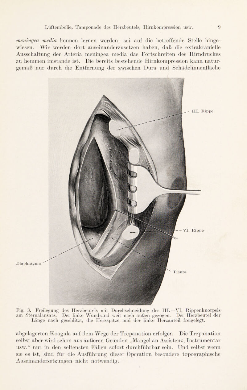 meningea meclia kennen lernen werden, sei auf die betreffende Stelle hinge- wiesen. Wir werden dort auseinanderzusetzen haben, daß die extrakranielle Ausschaltung der Arteria meningea media das Fortschreiten des Hirndruckes zu hemmen imstande ist. Die bereits bestehende Hirnkompression kann natur¬ gemäß nur durch die Entfernung der zwischen Dura und Schädelinnenfläche Diaphragma — VI. Rippe ^ Pleura - III. Rippe Fig. 3. Freilegung des Flerzbeutels mit Durchschneidung des III. —VI. Rippenknorpels am Sternalansatz. Der linke Wundrand weit nach außen gezogen. Der Herzbeutel der Länge nach geschlitzt, die Herzspitze und der linke Herzanteil freigelegt. abgelagerten Koagula auf dem Wege der Trepanation erfolgen. Die Trepanation selbst aber wird schon aus äußeren Gründen „Mangel an Assistenz, Instrumentar uswA nur in den seltensten Fällen sofort durchführbar sein. Und selbst wenn sie es ist, sind für die Ausführung dieser Operation besondere topographische Auseinandersetzungen nicht notwendig.