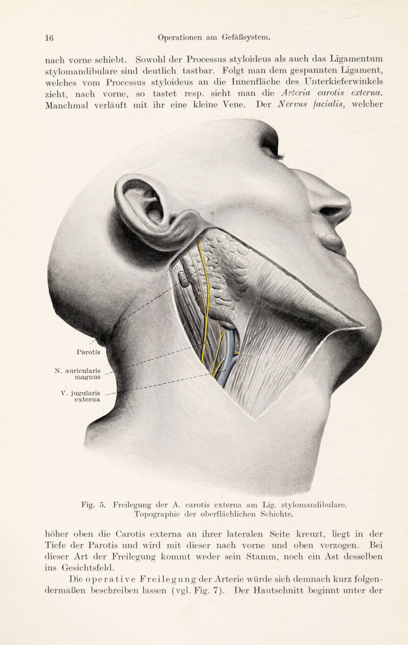 nach vorne schiebt. Sowohl der Processus styloideus als auch das Ligamentum stylomandibulare sind deutlich tastbar. Folgt man dem gespannten Ligament, welches vom Processus styloideus an die Innenfläche des lTnterkieferwinkels zieht, nach vorne, so tastet resp. sieht man die Arteria carotis externa. Manchmal verläuft mit ihr eine kleine Vene. Der Nervus facialis, welcher Fig. 5. Freilegung der A. carotis externa am Lig. stylomandibulare. Topographie der oberflächlichen Schichte. höher oben die Carotis externa an ihrer lateralen Seite kreuzt, liegt in der Tiefe der Parotis und wird mit dieser nach vorne und oben verzogen. Bei dieser Art der Freilegung kommt weder sein Stamm, noch ein Ast desselben ins Gesichtsfeld. Die operative Freilegung der Arterie würde sich demnach kurz folgen¬ dermaßen beschreiben lassen (vgl. Fig. 7). Der Hautschnitt beginnt unter der