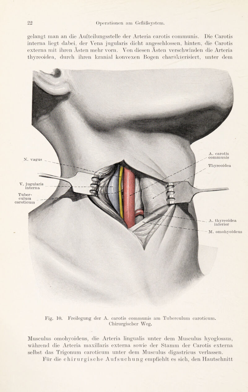 gelangt man an die Aufteilnngsstelle der Arteria carotis communis. Die Carotis interna liegt dabei, der Vena jugularis dicht angeschlossen, hinten, die Carotis externa mit ihren Ästen mehr vorn. Von diesen Ästen verschwinden die Arteria thvreoidea, durch ihren kranial konvexen Bogen charakterisiert, unter dem N. vagus V. jugularis interna Tuber¬ culum caroticum A. thyreoidea inferior M. omohyoideus A. carotis / communis Thyreoidea, Fig. 10. Freilegung der A. carotis communis am Tuberculum caroticum. Chirurgischer Weg. Muscnlus omohyoideus, die Arteria lingualis unter dem Musculus hyoglossus, während die Arteria maxillaris externa sowie der Stamm der Carotis externa selbst das Trigonum caroticum unter dem Musculus digastricus verlassen. Für die chirurgische Aufsuchung empfiehlt es sich, den Hautschnitt