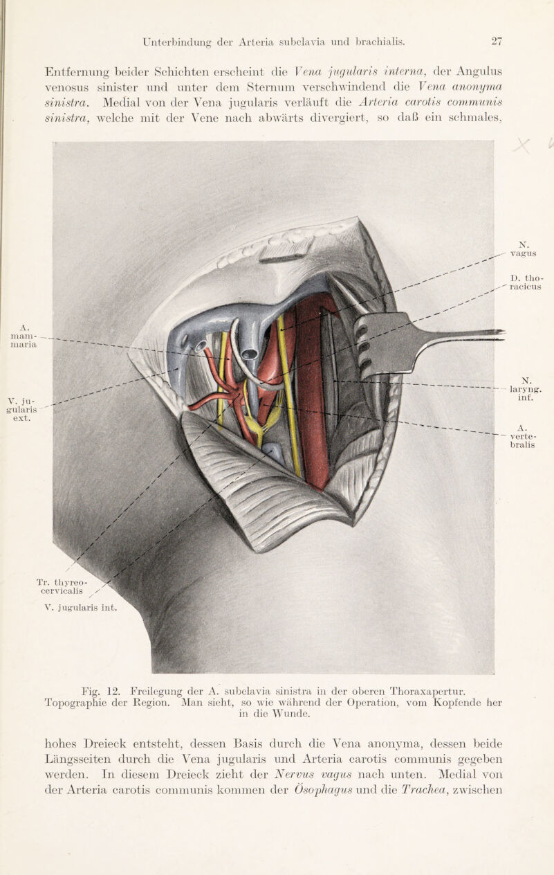 <*3 << Entfernung beider Schichten erscheint die Vena jugularis interna, der Angulus venosus sinister und unter dem Sternum verschwindend die Vena anonyma sinistra. Medial von der Vena jugularis verläuft die Arteria carotis communis sinistra, welche mit der Vene nach abwärts divergiert, so daß ein schmales, Tr. thyreo - cervicalis / / V. jugularis int. A. mam- — __ maria r- ju- ularis ext. Fig. 12. Freilegung der A. subclavia sinistra in der oberen Thoraxapertur. Topographie der Region. Man sieht, so wie während der Operation, vom Kopfende her in die Wunde. hohes Dreieck entsteht, dessen Basis durch die Vena anonyma, dessen beide Längsseiten durch die Vena jugularis und Arteria carotis communis gegeben werden. In diesem Dreieck zieht der Nervus vagus nach unten. Medial von der Arteria carotis communis kommen der Ösophagus und die Trachea, zwischen N. vagus D. tho- racicus N. laryng. inf. A. verte - bralis