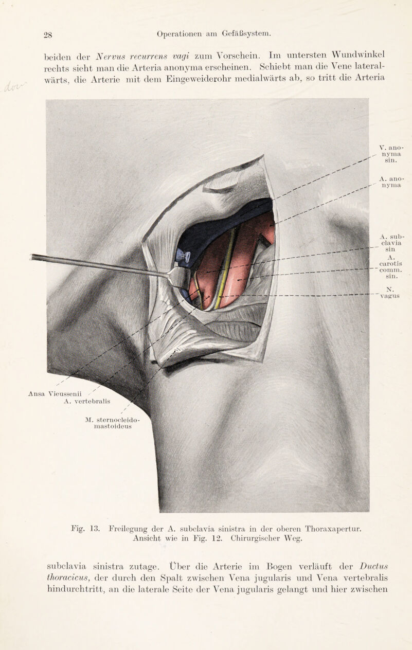 beiden der Nervus recurrens vagi zum Vorschein. Im untersten Wundwinkel rechts sieht man die Arteria anonyma erscheinen. Schiebt man die Vene lateral- wärts, die Arterie mit dem Eingeweiderohr medialwärts ab, so tritt die Arteria Ansa Vieussenii A. vertebralis M. sternocleido mastoideus Y. ano¬ nyma sin. A. ano¬ nyma j| A. sub- _ clavia sin A. 9 carotis % co mm. sin. N. fff vag'us Fig. 13. Freilegung der A. subclavia sinistra in der oberen Thoraxapertur. Ansicht wie in Fig. 12. Chirurgischer Weg. subclavia sinistra zutage. Über die Arterie im Bogen verläuft der Ductus thoracicus, der durch den Spalt zwischen Vena jugularis und Vena vertebralis hindurchtritt, an die laterale Seite der Vena jugularis gelangt und hier zwischen