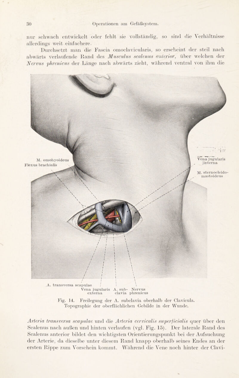 nur schwach entwickelt oder fehlt sie vollständig, so sind die Verhältnisse allerdings weit einfachere. Durchsetzt man die Fascia omoclavicularis, so erscheint der steil nach abwärts verlaufende Rand des Musculus scalenus anterior, über welchen der Nervus phrenicus der Länge nach abwärts zieht, während ventral von ihm die M. omohyoideus Flexus brachialis \ m A Vena jngnlaris [interna M. sternocleido- mastoideus transversa scapulae Vena jugularis A. sub- Nervus externa clavia phrenicus Fig. 14. Freilegung der A. subclavia oberhalb der Clavicula. Topographie der oberflächlichen Gebilde in der Wunde. Arteria transversa scapulae und die Arteria cervicalis superficialis quer über den Scalenus nach außen und hinten verlaufen (vgl. Fig. 15). Der laterale Rand des Scalenus anterior bildet den wichtigsten Orientierungspunkt bei der Aufsuchung der Arterie, da dieselbe unter diesem Rand knapp oberhalb seines Endes an der ersten Rippe zum Vorschein kommt. Während die Vene noch hinter der Clavi-