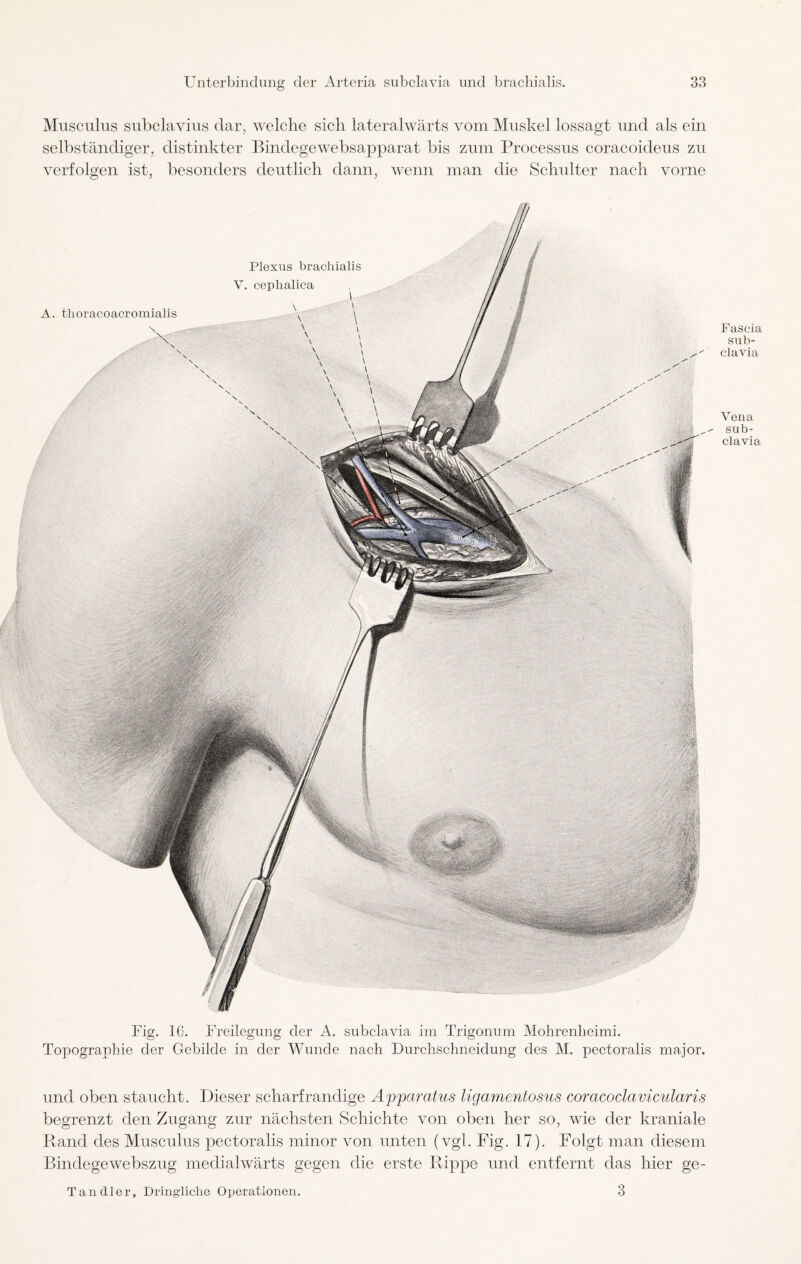 Musculus subclavius dar, welche sich lateralwärts vom Muskel lossagt und als ein selbständiger, distinkter Bindegewebsapparat bis zum Processus coracoideus zu verfolgen ist, besonders deutlich dann, wenn man die Schulter nach vorne Fascia sub¬ clavia Vena sub¬ clavia Fig. 16. Freilegung der A. subclavia im Trigonum Mohrenlieimi. Topographie der Gebilde in der Wunde nach Durchschneidung des M. pectoralis major. und oben staucht. Dieser scharfrandige Apparatus ligamentosus coracoclavicularis begrenzt den Zugang zur nächsten Schichte von oben her so, wie der kraniale Rand des Musculus pectoralis minor von unten (vgl. Fig. 17). Folgt man diesem Bindegewebszug medialwärts gegen die erste Rippe und entfernt das hier ge- 3 Tandler, Dringliche Operationen.