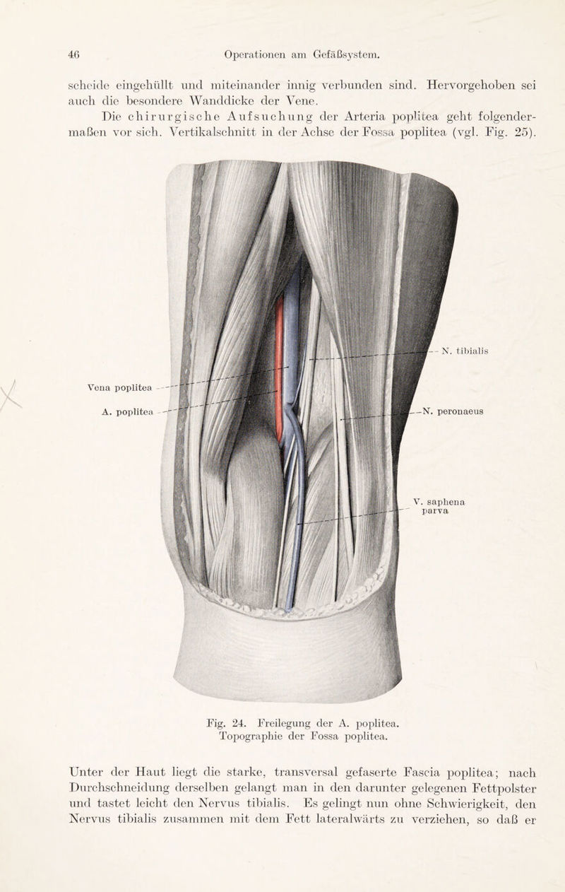 scheide eingehüllt und miteinander innig verbunden sind. Hervorgehoben sei auch die besondere Wanddicke der Vene. Die chirurgische Aufsuchung der Arteria poplitea geht folgender¬ maßen vor sich. Vertikalschnitt in der Achse derFossa poplitea (vgl. Fig. 25). -N. peronaeus V. saphena parva Vena poplitea A. poplitea --f — N. tibialis Fig. 24. Freilegung der A. poplitea. Topographie der Fossa poplitea. Unter der Haut liegt die starke, transversal gefaserte Fascia poplitea; nach Durchschneidung derselben gelangt man in den darunter gelegenen Fettpolster und tastet leicht den Nervus tibialis. Es gelingt nun ohne Schwierigkeit, den Nervus tibialis zusammen mit dem Fett lateralwärts zu verziehen, so daß er