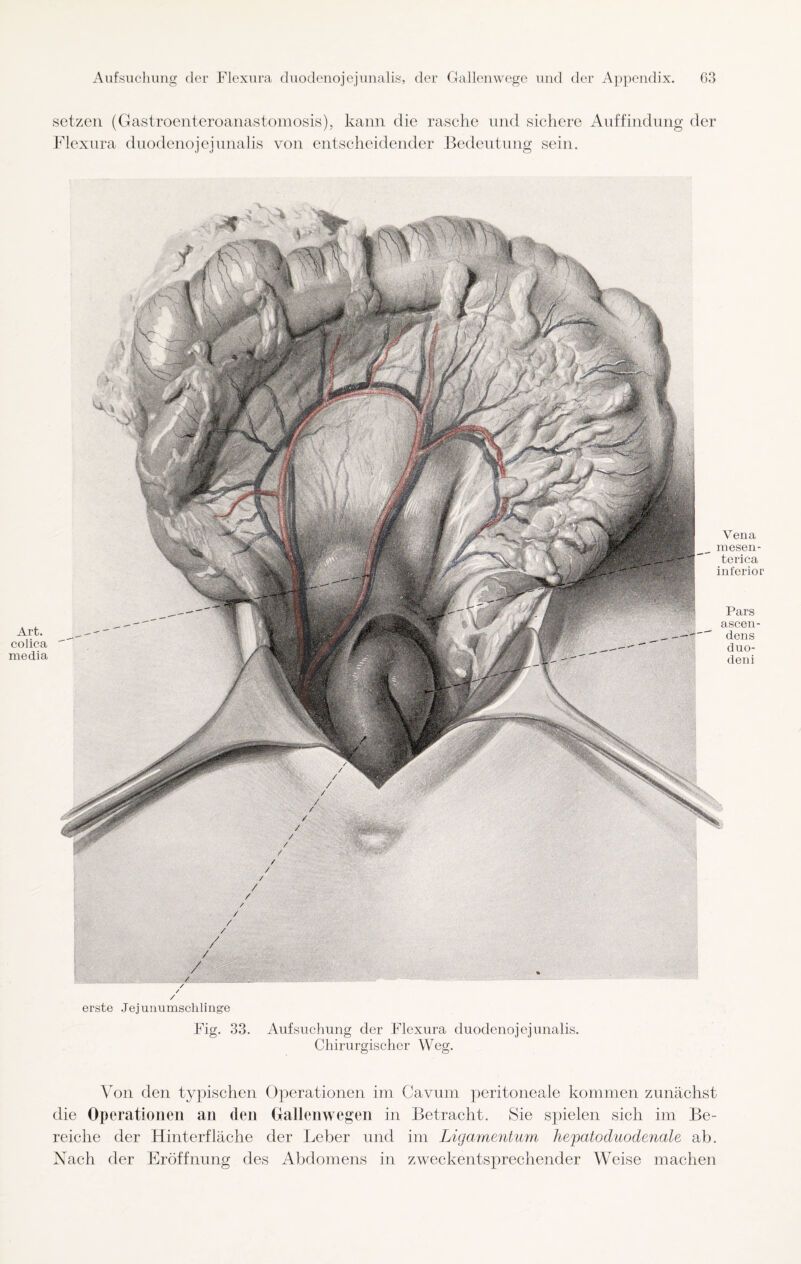 Art. colica media setzen (Gastroenteroanastomosis), kann die rasche und sichere Auffindung der Flexura duodenojejunalis von entscheidender Bedeutung sein. Vena mesen- terica inferior Pars ascen- dens duo- deni erste Jejunumschlinge Fig. 33. Aufsuchung der Flexura duodenojejunalis. Chirurgischer Weg. Von den typischen Operationen im Cavum peritoneale kommen zunächst die Operationen an den Gallenwegen in Betracht. Sie spielen sich im Be¬ reiche der Hinterfläche der Leber und im Ligamentum hepatoduodenale ab. Nach der Eröffnung des Abdomens in zweckentsprechender Weise machen