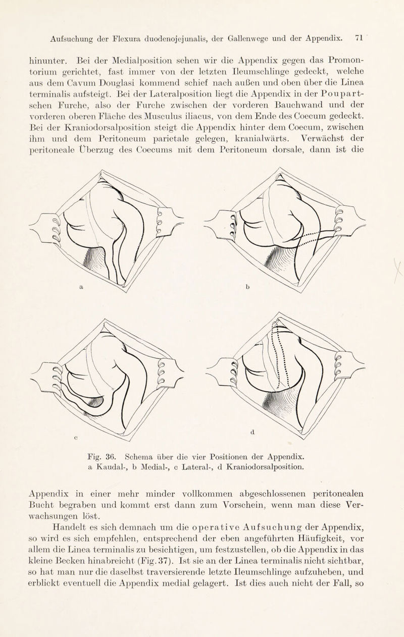 hinunter. Bei der Medialposition sehen wir die Appendix gegen das Promon¬ torium gerichtet, fast immer von der letzten Ileumschlinge gedeckt, welche aus dem Cavum Douglasi kommend schief nach außen und oben über die Linea terminalis auf steigt. Bei der Lateralposition liegt die Appendix in der Poupart- schen Furche, also der Furche zwischen der vorderen Bauchwand und der vorderen oberen Fläche des Musculus iliacus, von dem Ende des Coecum gedeckt. Bei der Kraniodorsalposition steigt die Appendix hinter dem Coecum, zwischen ihm und dem Peritoneum parietale gelegen, kranialwärts. Verwächst der peritoneale Überzug des Coecums mit dem Peritoneum dorsale, dann ist die Fig. 36. Schema über die vier Positionen der Appendix, a Kaudal-, b Medial-, c Lateral-, d Kraniodorsalposition. Appendix in einer mehr minder vollkommen abgeschlossenen peritonealen Bucht begraben und kommt erst dann zum Vorschein, wenn man diese Ver¬ wachsungen löst. Handelt es sich demnach um die operative Aufsuchung der Appendix, so wird es sich empfehlen, entsprechend der eben angeführten Häufigkeit, vor allem die Linea terminalis zu besichtigen, um festzustellen, ob die Appendix in das kleine Becken hinabreicht (Fig. 37). Ist sie an der Linea terminalis nicht sichtbar, so hat man nur die daselbst traversierende letzte Ileumschlinge aufznheben, und erblickt eventuell die Appendix medial gelagert. Ist dies auch nicht der Fall, so