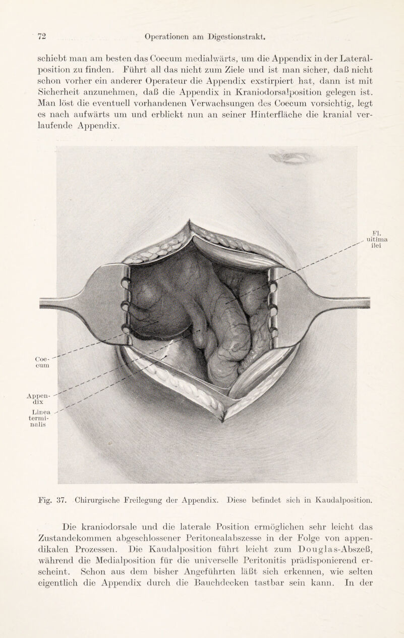 schiebt man am besten das Coecum mediahvärts, um die Appendix in der Lateral¬ position zu finden. Führt all das nicht zum Ziele und ist man sicher, daß nicht schon vorher ein anderer Operateur die Appendix exstirpiert hat, dann ist mit Sicherheit anzunehmen, daß die Appendix in Kraniodorsalposition gelegen ist. Man löst die eventuell vorhandenen Verwachsungen dos Coecum vorsichtig, legt es nach aufwärts um und erblickt nun an seiner Hinterfläche die kranial ver¬ laufende Appendix. Coe¬ cum Appen¬ dix Linea termi- nalis Fl. ultima iiei Fig. 37. Chirurgische Freilegung der Appendix. Diese befindet sich in Kaudalposition. Die kraniodorsale und die laterale Position ermöglichen sehr leicht das Zustandekommen abgeschlossener Peritonealabszesse in der Folge von appen- clikalen Prozessen. Die Kaudalposition führt leicht zum Douglas-Abszeß, während die Medialposition für die universelle Peritonitis prädisponierend er¬ scheint. Schon aus dem bisher Angeführten läßt sich erkennen, wie selten eigentlich die Appendix durch die Bauchdecken tastbar sein kann. In der