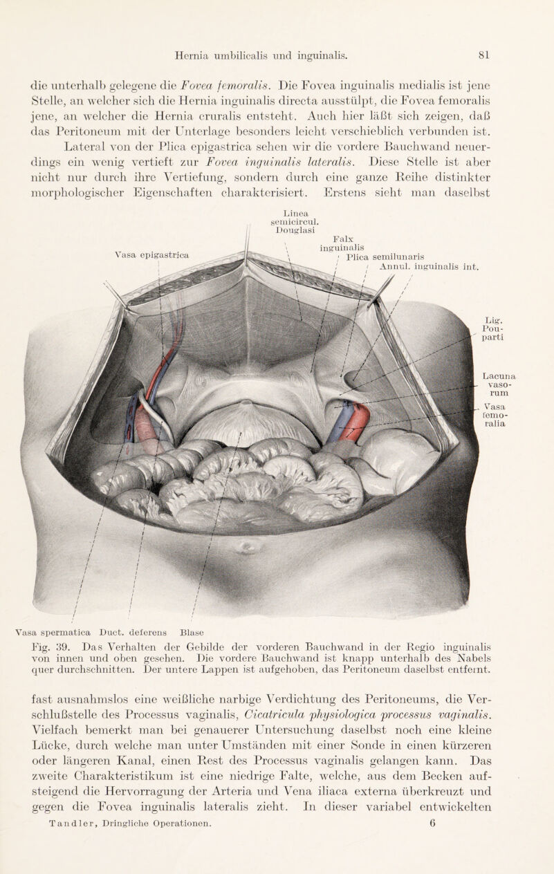 die unterhalb gelegene die Fovea femoralis. Die Fovea inguinalis medialis ist jene Stelle, an welcher sich die Hernia inguinalis clirecta ausstülpt, die Fovea femoralis jene, an welcher die Hernia cruralis entsteht. Auch hier läßt sich zeigen, daß das Peritoneum mit der Unterlage besonders leicht verschieblich verbunden ist. Lateral von der Plica epigastrica sehen wir die vordere Bauchwand neuer¬ dings ein wenig vertieft zur Fovea inguinalis lateralis. Diese Stelle ist aber nicht nur durch ihre Vertiefung, sondern durch eine ganze Reihe distinkter morphologischer Eigenschaften charakterisiert. Erstens sieht man daselbst Lig. Pou- parti Vasa epigastrica Linea semicircul. Douglasi Falx inguinalis Plica semilunaris / Annul. inguinalis int. YTasa t'emo- ralia SÄ Lacuna vaso- rum Vasa spermatica Duct. deferens Blase Fig. 39. Das Verhalten der Gebilde der vorderen Bauchwand in der Regio inguinalis von innen und oben gesehen. Die vordere Bauchwand ist knapp unterhalb des Nabels quer durchschnitten. Der untere Lappen ist aufgehoben, das Peritoneum daselbst entfernt. fast ausnahmslos eine weißliche narbige Verdichtung des Peritoneums, die Ver¬ schlußstelle des Processus vaginalis, Cicatricula physiologica processus vaginalis. Vielfach bemerkt man bei genauerer Untersuchung daselbst noch eine kleine Lücke, durch welche man unter Umständen mit einer Sonde in einen kürzeren oder längeren Kanal, einen Rest des Processus vaginalis gelangen kann. Das zweite Charakteristikum ist eine niedrige Falte, welche, aus dem Becken auf- steigend die Hervorragung der Arteria und Vena iliaca externa überkreuzt und gegen die Fovea inguinalis lateralis zieht. In dieser variabel entwickelten Tandler, Dringliche Operationen. 6