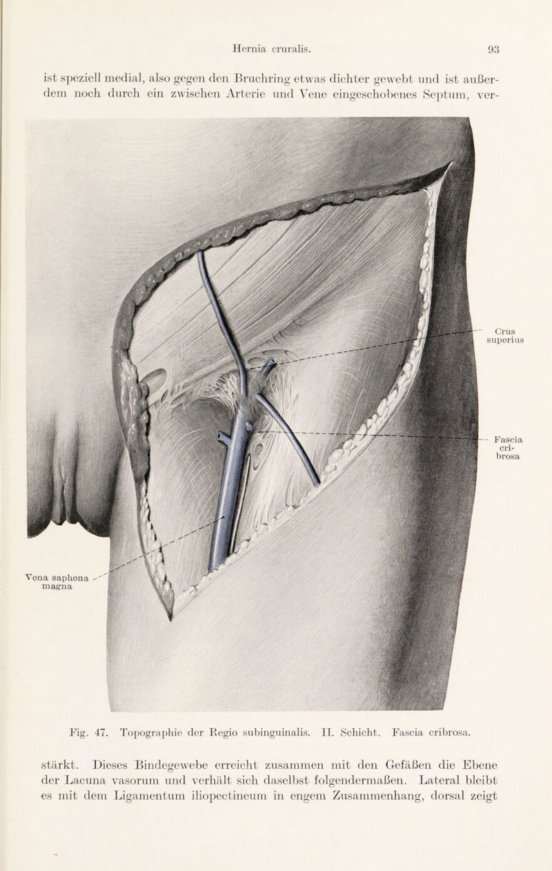 Fig. 47. Topographie der Regio subinguinalis. II. Schicht. Fascia cribrosa. stärkt. Dieses Bindegewebe erreicht zusammen mit den Gefäßen die Ebene der Lacuna vasorum und verhält sich daselbst folgendermaßen. Lateral bleibt es mit dem Ligamentum iliopectineum in engem Zusammenhang, dorsal zeigt ist speziell medial, also gegen den Bruchring etwas dichter gewebt und ist außer¬ dem noch durch ein zwischen Arterie und Vene eingeschobenes Septum, ver- Crus superius Fascia cri¬ brosa Vena saphena magna