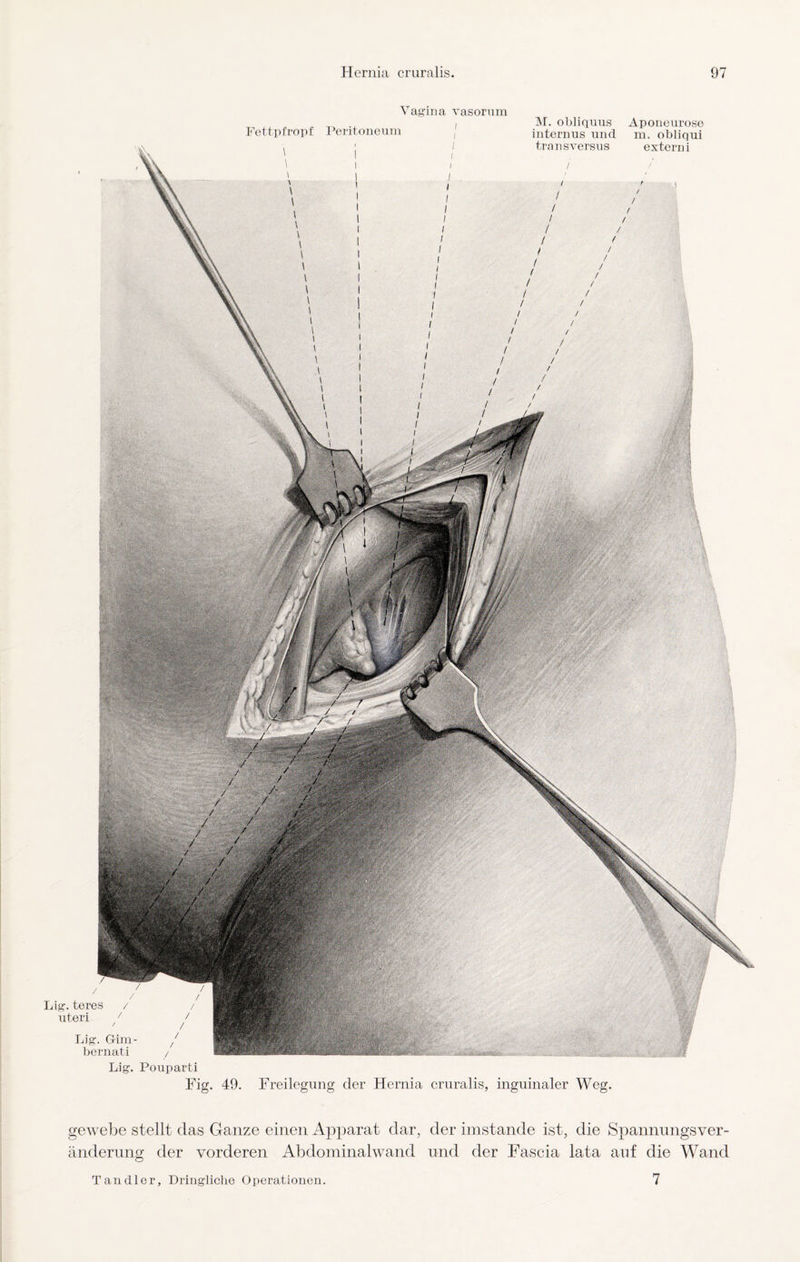 Vagina vasorum Fettpfropf Peritoneum M. obliquus Aponeurose internus und m. obliqui tra ns versus extern i Lig.teres / uteri Lig. Gim bernati ' f - • Lig. Pouparti Fig. 49. Freilegung der Hernia cruralis, inguinaler Weg. gewebe stellt das Ganze einen Apparat dar, der imstande ist, die Spannungsver¬ änderung der vorderen Abdominalwand und der Fascia lata auf die Wand 7 Tandler, Dringliche Operationen.