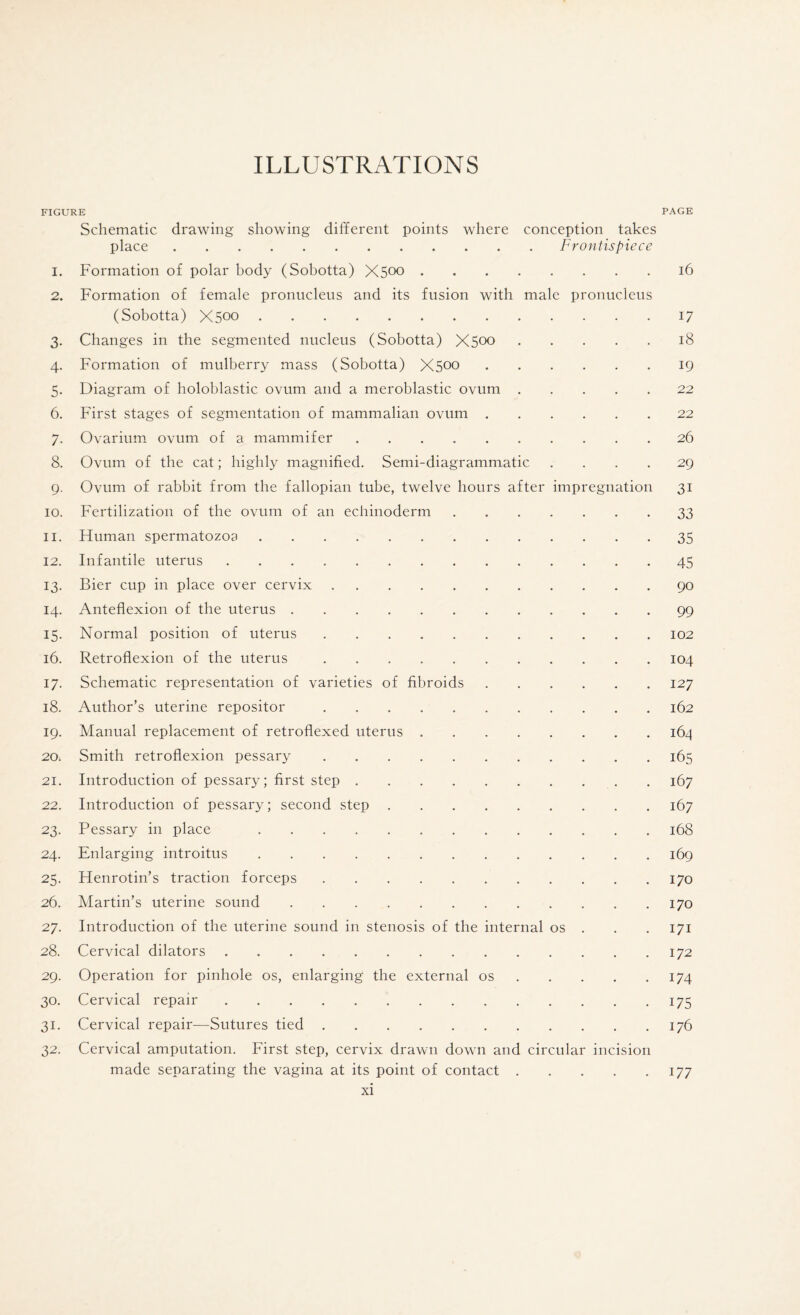 ILLUSTRATIONS FIGURE PAGE Schematic drawing showing different points where conception takes place.Frontispiece 1. Formation of polar body (Sobotta) X500.16 2. Formation of female pronucleus and its fusion with male pronucleus (Sobotta) X500.17 3. Changes in the segmented nucleus (Sobotta) X500.18 4. Formation of mulberry mass (Sobotta) X500.19 5. Diagram of holoblastic ovum and a meroblastic ovum.22 6. First stages of segmentation of mammalian ovum.22 7. Ovarium ovum of a mammifer.26 8. Ovum of the cat; highly magnified. Semi-diagrammatic .... 29 9. Ovum of rabbit from the fallopian tube, twelve hours after impregnation 31 10. Fertilization of the ovum of an echinoderm.33 11. Human spermatozoa.35 12. Infantile uterus.45 13. Bier cup in place over cervix.90 14. Anteflexion of the uterus.99 15. Normal position of uterus.102 16. Retroflexion of the uterus.104 17. Schematic representation of varieties of fibroids.127 18. Author’s uterine repositor.162 19. Manual replacement of retroflexed uterus.164 20; Smith retroflexion pessary.165 21. Introduction of pessary; first step.167 22. Introduction of pessary; second step.167 23. Pessary in place .168 24. Enlarging introitus.169 25. Henrotin’s traction forceps.170 26. Martin’s uterine sound.170 27. Introduction of the uterine sound in stenosis of the internal os . . .171 28. Cervical dilators.172 29. Operation for pinhole os, enlarging the external os.174 30. Cervical repair.175 31. Cervical repair—Sutures tied.176 32. Cervical amputation. First step, cervix drawn down and circular incision made separating the vagina at its point of contact.177