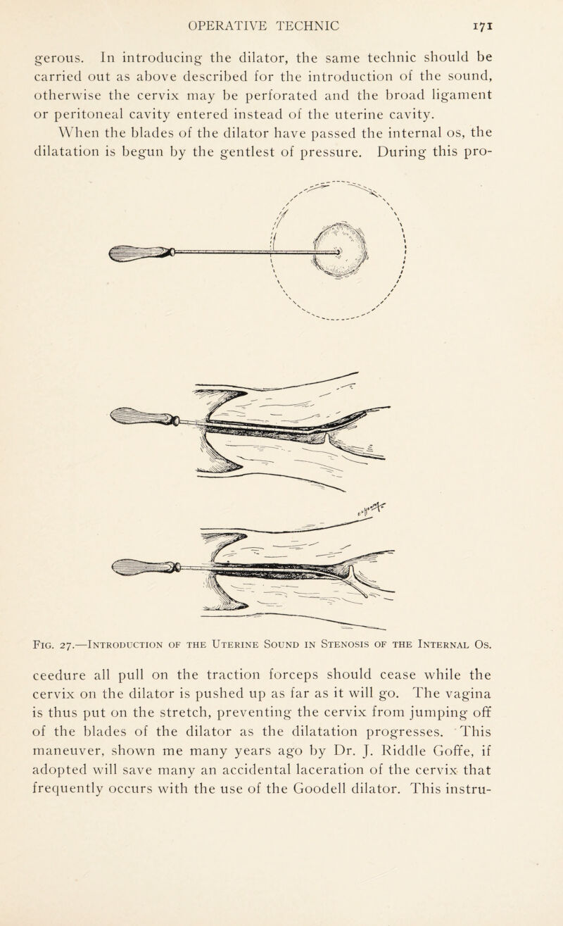 gerous. In introducing the dilator, the same technic should be carried out as above described for the introduction of the sound, otherwise the cervix may be perforated and the broad ligament or peritoneal cavity entered instead of the uterine cavity. When the blades of the dilator have passed the internal os, the dilatation is begun by the gentlest of pressure. During this pro- Fig. 27.—Introduction of the Uterine Sound in Stenosis of the Internal Os. ceedure all pull on the traction forceps should cease while the cervix on the dilator is pushed up as far as it will go. The vagina is thus put on the stretch, preventing the cervix from jumping off of the blades of the dilator as the dilatation progresses. This maneuver, shown me many years ago by Dr. J. Riddle Goffe, if adopted will save many an accidental laceration of the cervix that frequently occurs with the use of the Goodell dilator. This instru-