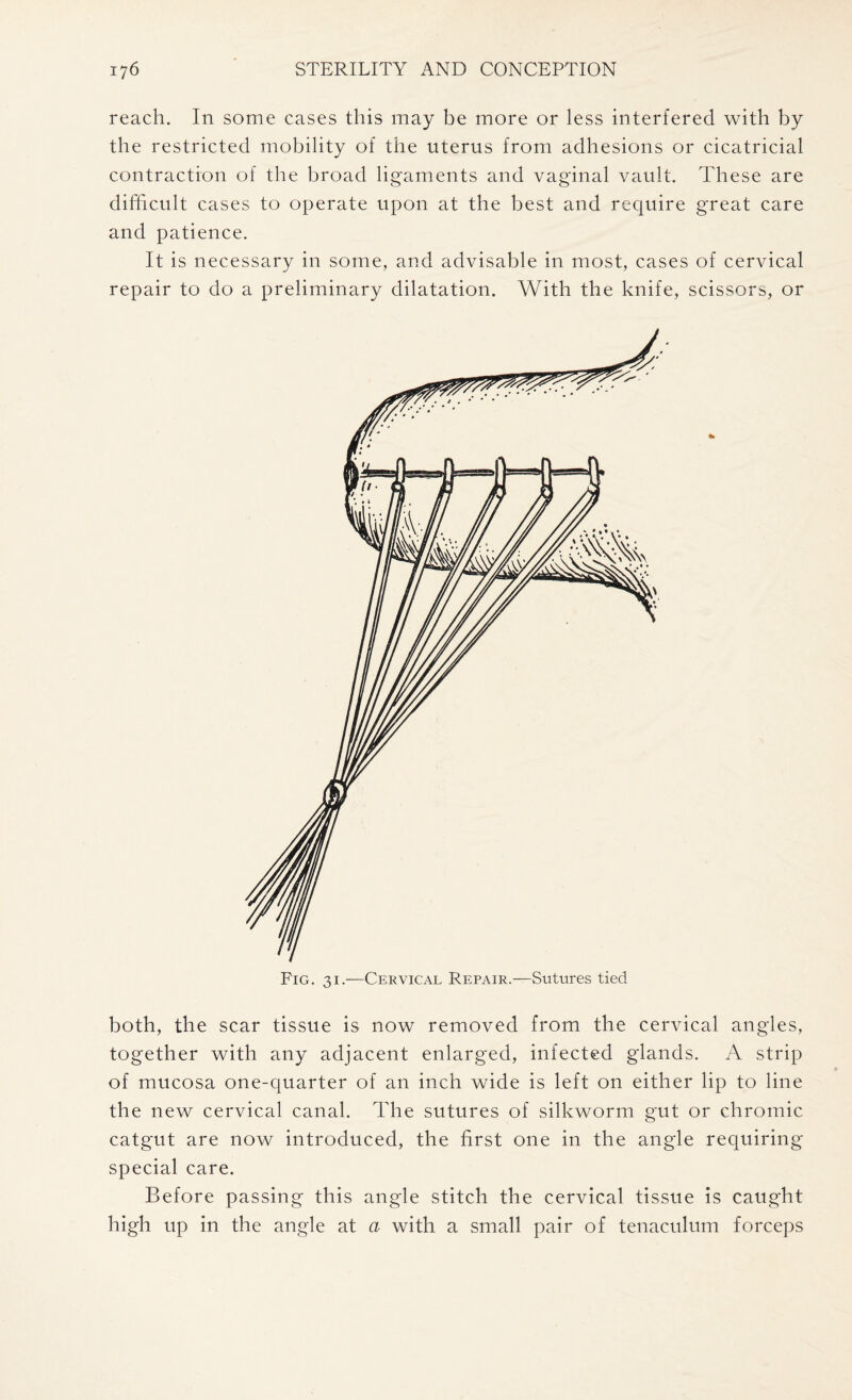 reach. In some cases this may be more or less interfered with by the restricted mobility of the uterus from adhesions or cicatricial contraction of the broad ligaments and vaginal vault. These are difficult cases to operate upon at the best and require great care and patience. It is necessary in some, and advisable in most, cases of cervical repair to do a preliminary dilatation. With the knife, scissors, or both, the scar tissue is now removed from the cervical angles, together with any adjacent enlarged, infected glands. A strip of mucosa one-quarter of an inch wide is left on either lip to line the new cervical canal. The sutures of silkworm gut or chromic catgut are now introduced, the first one in the angle requiring special care. Before passing this angle stitch the cervical tissue is caught high up in the angle at a with a small pair of tenaculum forceps