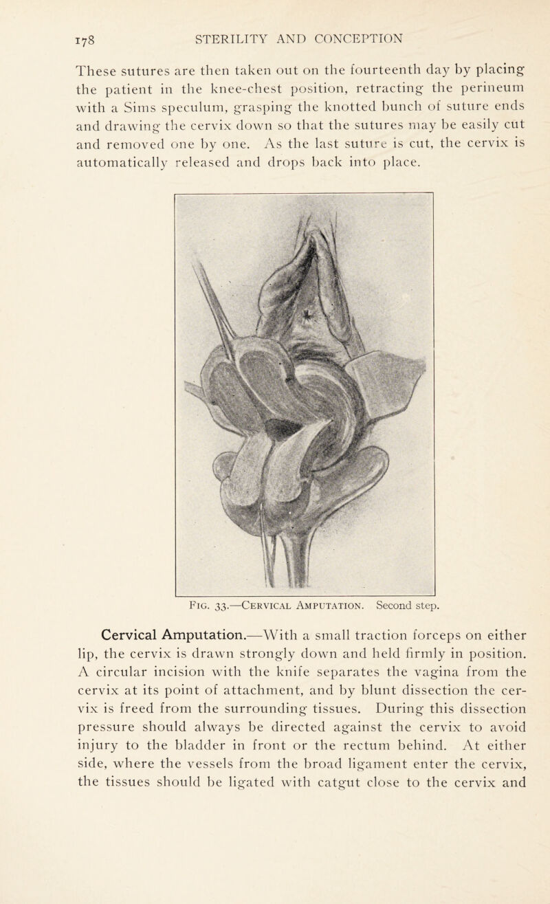 These sutures are then taken out on the fourteenth clay by placing the patient in the knee-chest position, retracting the perineum with a Sims speculum, grasping the knotted bunch of suture ends and drawing the cervix down so that the sutures may be easily cut and removed one by one. As the last suture is cut, the cervix is automatically released and drops back into place. Fig. 33.—Cervical Amputation. Second step. Cervical Amputation.—With a small traction forceps on either lip, the cervix is drawn strongly down and held firmly in position. A circular incision with the knife separates the vagina from the cervix at its point of attachment, and by blunt dissection the cer¬ vix is freed from the surrounding tissues. During this dissection pressure should always be directed against the cervix to avoid injury to the bladder in front or the rectum behind. At either side, where the vessels from the broad ligament enter the cervix, the tissues should be ligated with catgut close to the cervix and