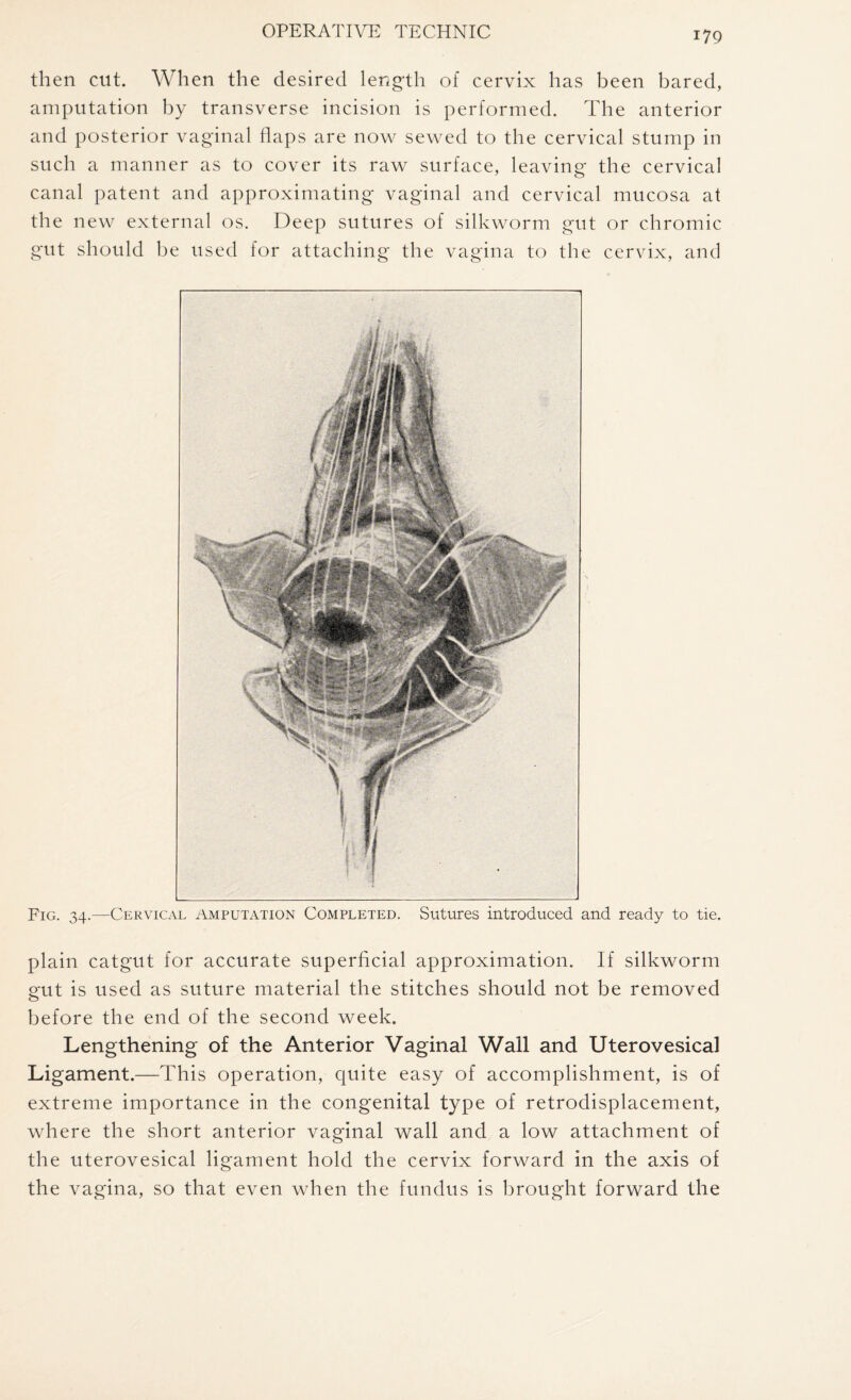 then cut. When the desired length of cervix has been bared, amputation by transverse incision is performed. The anterior and posterior vaginal flaps are now sewed to the cervical stump in such a manner as to cover its raw surface, leaving the cervical canal patent and approximating vaginal and cervical mucosa at the new external os. Deep sutures of silkworm gut or chromic gut should be used for attaching the vagina to the cervix, and Fig. 34.—Cervical Amputation Completed. Sutures introduced and ready to tie. plain catgut for accurate superficial approximation. If silkworm gut is used as suture material the stitches should not be removed before the end of the second week. Lengthening of the Anterior Vaginal Wall and Uterovesical Ligament.—This operation, quite easy of accomplishment, is of extreme importance in the congenital type of retrodisplacement, where the short anterior vaginal wall and a low attachment of the uterovesical ligament hold the cervix forward in the axis of the vagina, so that even when the fundus is brought forward the