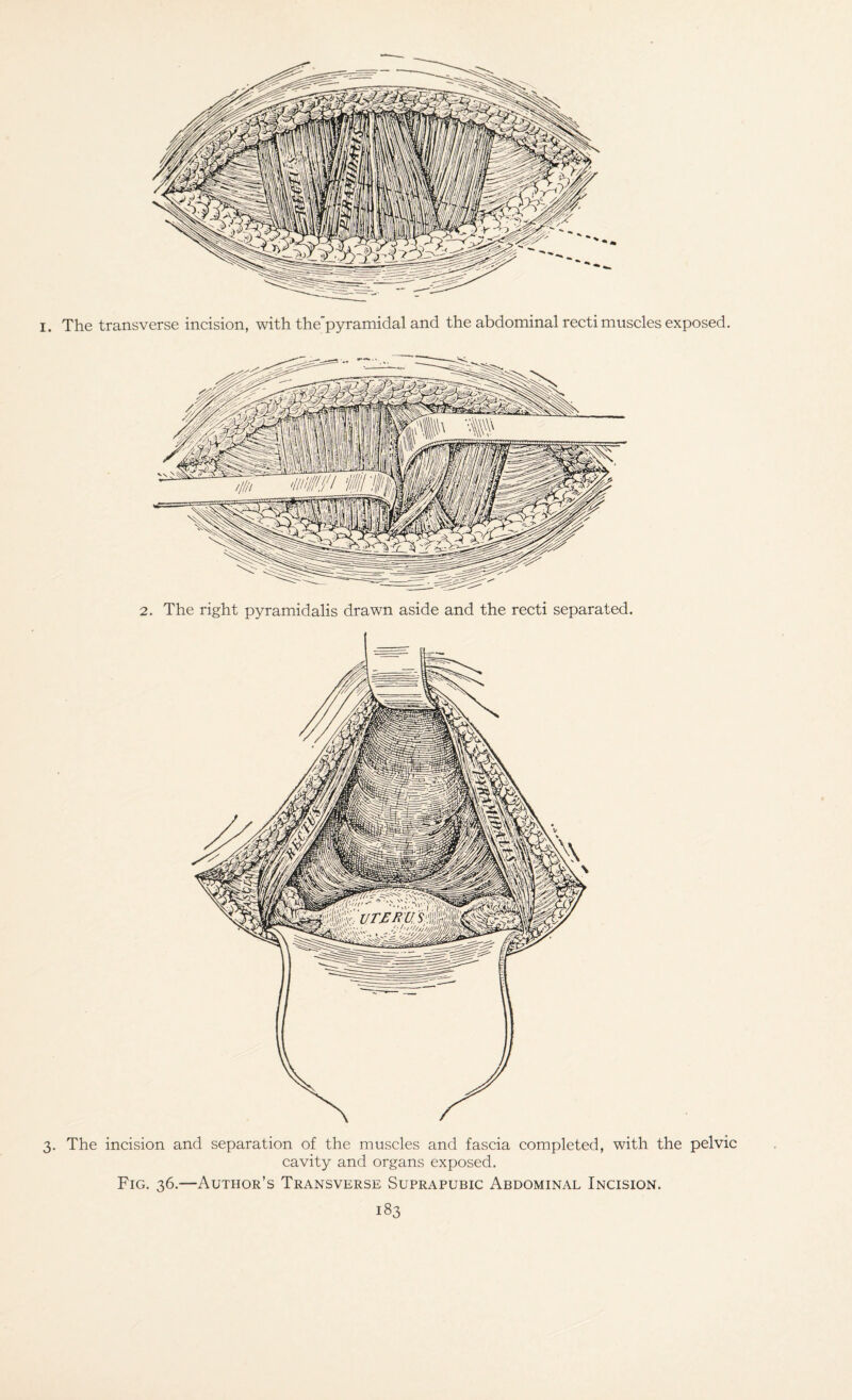 The transverse incision, with the'pyramidal and the abdominal recti muscles exposed. 2. The right pyramidalis drawn aside and the recti separated. 3. The incision and separation of the muscles and fascia completed, with the pelvic cavity and organs exposed. Fig. 36.—Author’s Transverse Suprapubic Abdominal Incision.