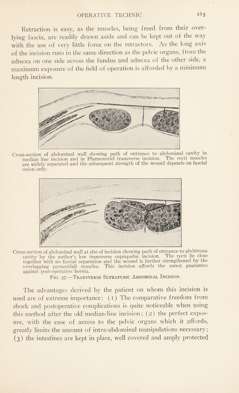 Retraction is easy, as the muscles, being freed from their over- lying fascia, are readily drawn aside and can be kept out of the way with the use of very little force on the retractors. As the long axis of the incision runs in the same direction as the pelvic organs, from the adnexa on one side across the fundus and adnexa of the other side, a maximum exposure of the held of operation is afforded by a minimum length incision. Cross-section of abdominal wall showing path of entrance to abdominal cavity in median line incision and in Pfannenstiel transverse incision. The recti muscles are widely separated and the subsequent strength of the wound depends on fascial union only. Cross-section of abdominal wall at site of incision showing path of entrance to abdomma cavity by the author’s low transverse suprapubic incision. The recti lie close together with no fascial separation and the wound is further strengthened by the overlapping pyramidali muscles. This incision affords the surest guarantee against post-operative hernia. Fig. 37.—Transverse Suprapubic Abdominal Incision. The advantages derived by the patient on whom this incision is used are of extreme importance: (1) The comparative freedom from shock and postoperative complications is quite noticeable when using this method after the old median-line incision; (2) the perfect expos¬ ure, with the ease of access to the pelvic organs which it affords, greatly limits the amount of intra-abdominal manipulations necessary; (3) the intestines are kept in place, well covered and amply protected