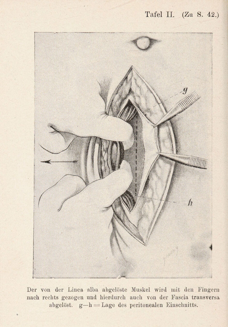 Der von der Linea alba abgelöste Muskel wird mit den Fingern nach rechts gezogen und hierdurch auch von der Fascia transversa abgelöst, g—h = Lage des peritonealen Einschnitts.