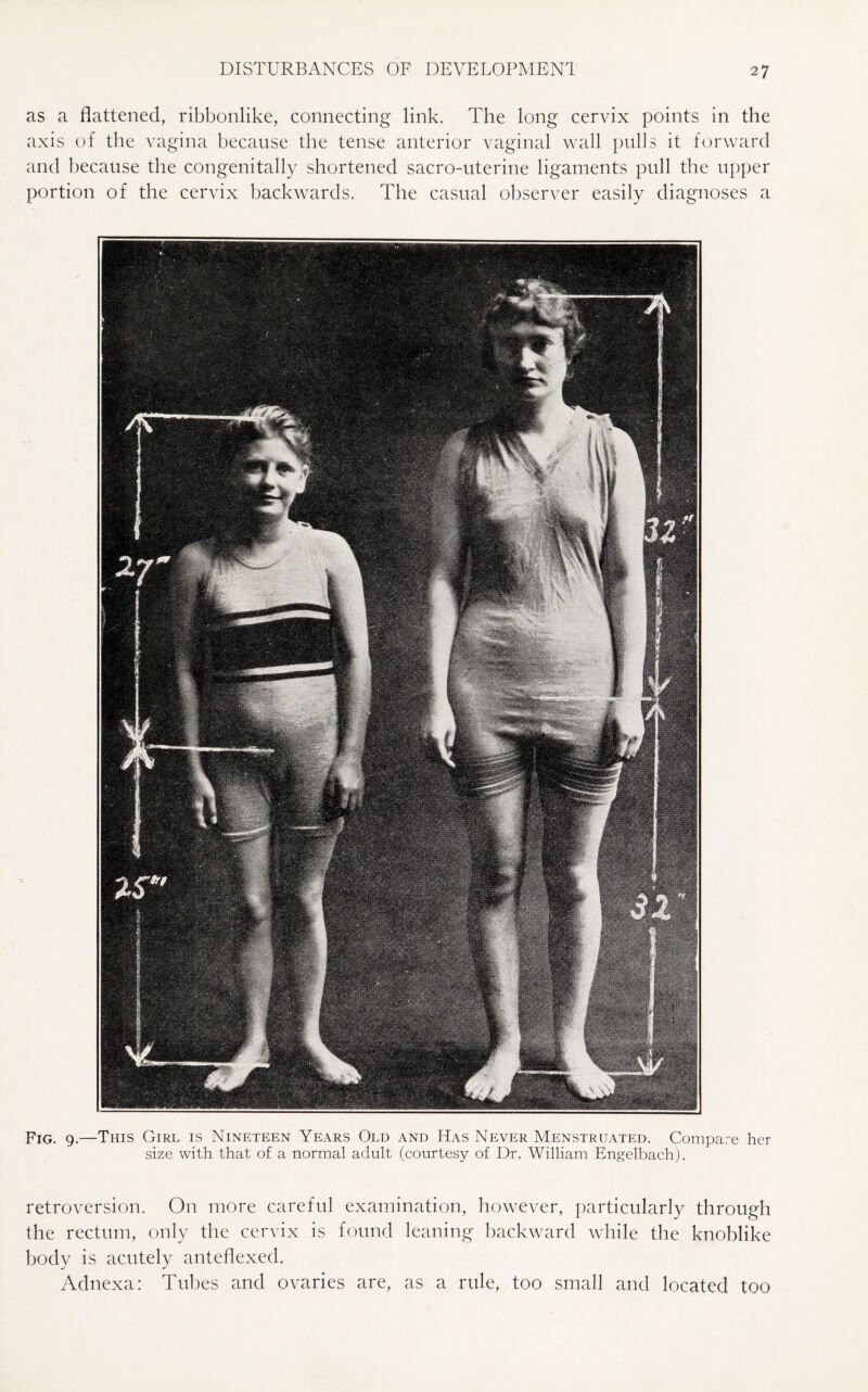 as a flattened, ribbonlike, connecting link. The long cervix points in the axis of the vagina because the tense anterior vaginal wall pulls it forward and because the congenitally shortened sacro-uterine ligaments pull the upper portion of the cervix backwards. The casual observer easily diagnoses a Fig. 9.—This Girl is Nineteen Years Old and Has Never Menstruated. Compare her size with that of a normal adult (courtesy of Dr. William Engelbach). retroversion. On more careful examination, however, particularly through the rectum, only the cervix is found leaning backward while the knoblike body is acutely anteflexed. Adnexa: Tubes and ovaries are, as a rule, too small and located too