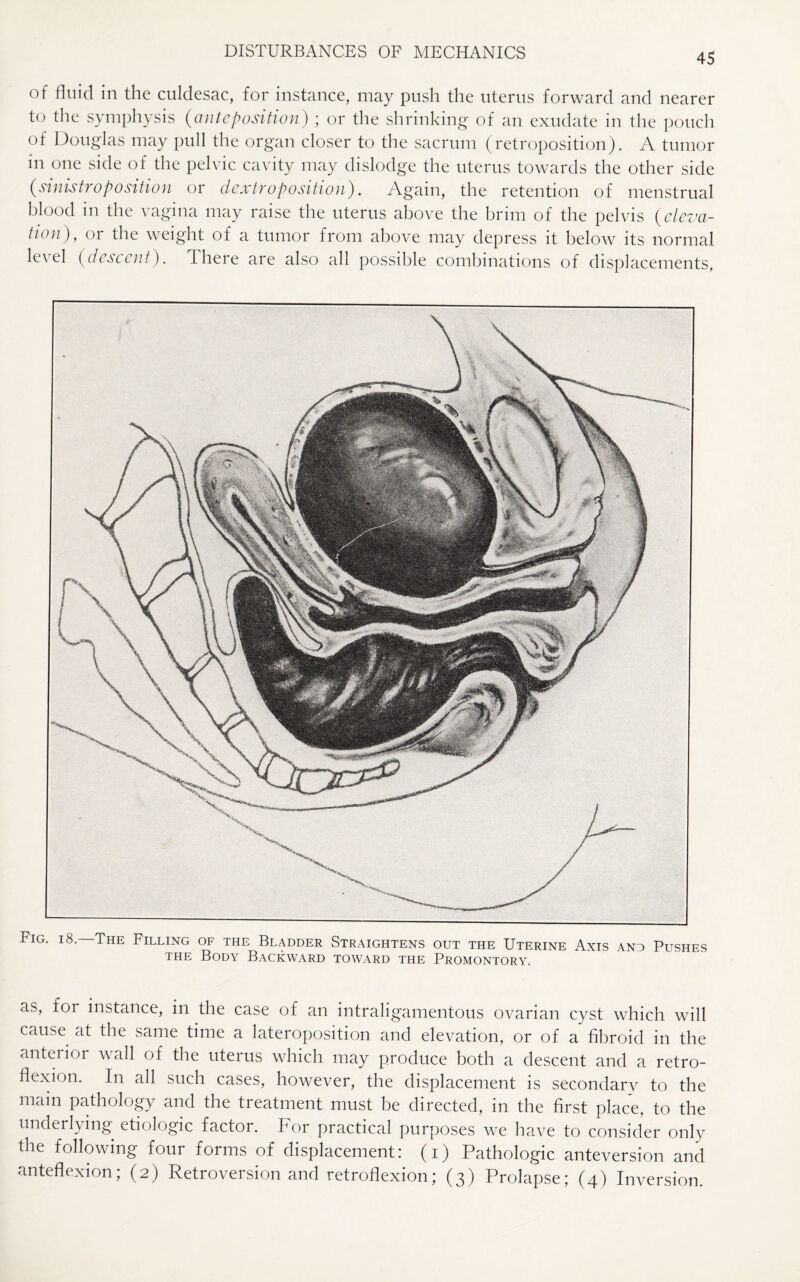 of fluid in the culdesac, for instance, may push the uterus forward and nearer to the symphysis {anteposition) ; or the shrinking of an exudate in the pouch of Douglas may pull the organ closer to the sacrum (retroposition). A tumor m one side of the pelvic cavity may dislodge the uterus towards the other side (sinistroposition or dextroposition). Again, the retention of menstrual blood in the vagina may raise the uterus above the brim of the pelvis {eleva¬ tion), or the weight of a tumor from above may depress it below its normal level {descent). There are also all possible combinations of displacements, Fig. i8. The Filling of the Bladder Straightens out the Uterine Axis and Pushes the Body Backward toward the Promontory. as, for instance, in the case of an intraligamentous ovarian cyst which will cause at the same time a lateroposition and elevation, or of a fibroid in the anterior wall of the uterus which may produce both a descent and a retro¬ flexion. In all such cases, however, the displacement is secondary to the main pathology and the treatment must be directed, in the first place, to the underlying etiologic factor. For practical purposes we have to consider only the following four forms of displacement: (i) Pathologic anteversion and anteflexion; (2) Retroversion and retroflexion; (3) Prolapse; (4) Inversion.