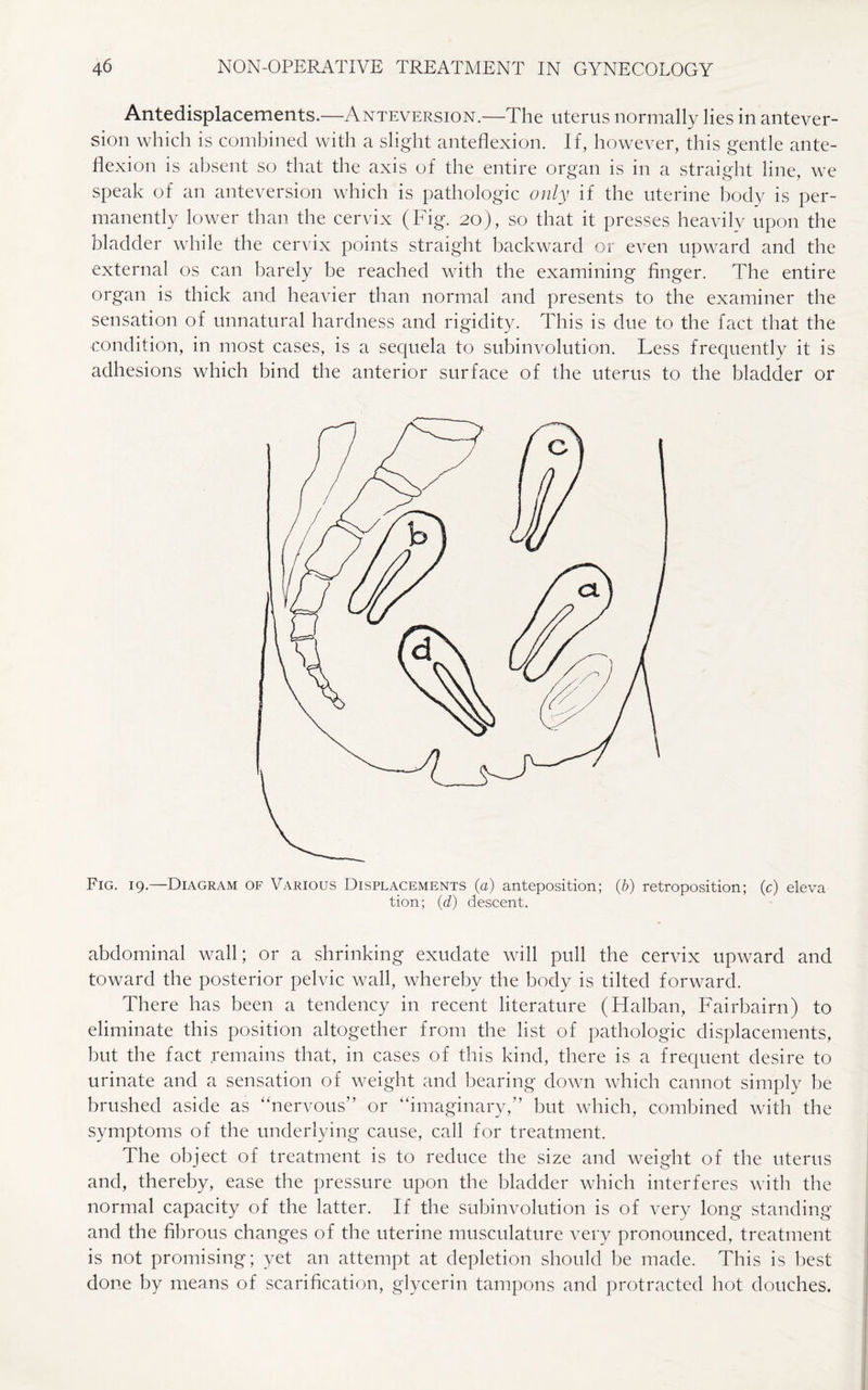 Antedisplacements.—-Anteversion.—The uterus normally lies in antever- sion which is combined with a slight anteflexion. If, however, this gentle ante¬ flexion is absent so that the axis of the entire organ is in a straight line, we speak of an anteversion which is pathologic only if the uterine body is per¬ manently lower than the cervix (Fig. 20), so that it presses heavily upon the bladder while the cervix points straight backward or even upward and the external os can barely be reached with the examining finger. The entire organ is thick and heavier than normal and presents to the examiner the sensation of unnatural hardness and rigidity. This is due to the fact that the condition, in most cases, is a sequela to subinvolution. Less frequently it is adhesions which bind the anterior surface of the uterus to the bladder or Fig. 19.—Diagram of Various Displacements (a) anteposition; (b) retroposition; (c) eleva tion; (d) descent. abdominal wall; or a shrinking exudate will pull the cervix upward and toward the posterior pelvic wall, whereby the body is tilted forward. There has been a tendency in recent literature (Halban, Fairbairn) to eliminate this position altogether from the list of pathologic displacements, but the fact remains that, in cases of this kind, there is a frequent desire to urinate and a sensation of weight and bearing down which cannot simply be brushed aside as “nervous” or “imaginary,” but which, combined with the symptoms of the underlying cause, call for treatment. The object of treatment is to reduce the size and weight of the uterus and, thereby, ease the pressure upon the bladder which interferes with the normal capacity of the latter. If the subinvolution is of very long standing and the fibrous changes of the uterine musculature very pronounced, treatment is not promising; yet an attempt at depletion should be made. This is best done by means of scarification, glycerin tampons and protracted hot douches.